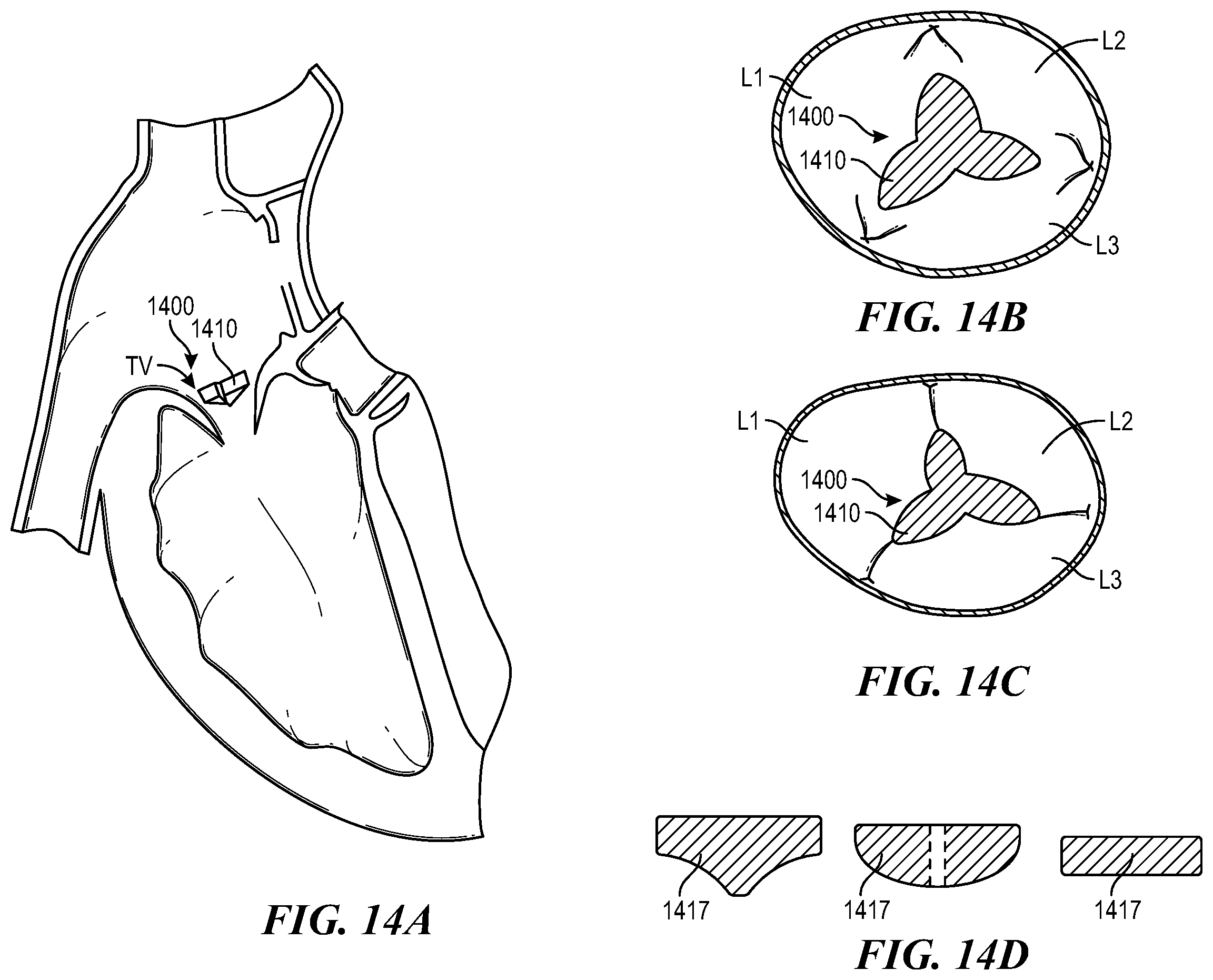 Patent US12588996 Figure 16 – Cardiac valve repair devices and associated systems and methods