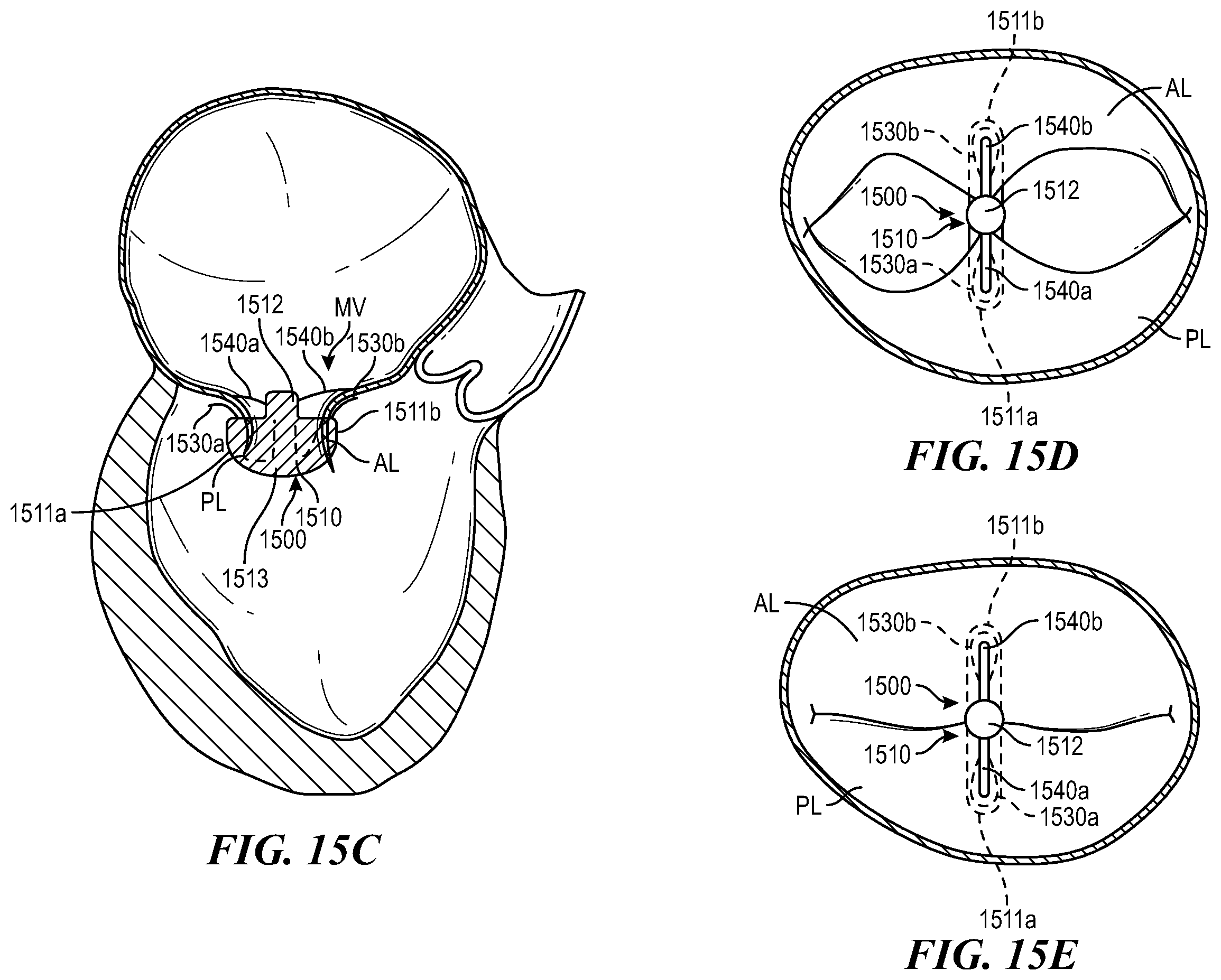 Patent US12588996 Figure 18 – Cardiac valve repair devices and associated systems and methods
