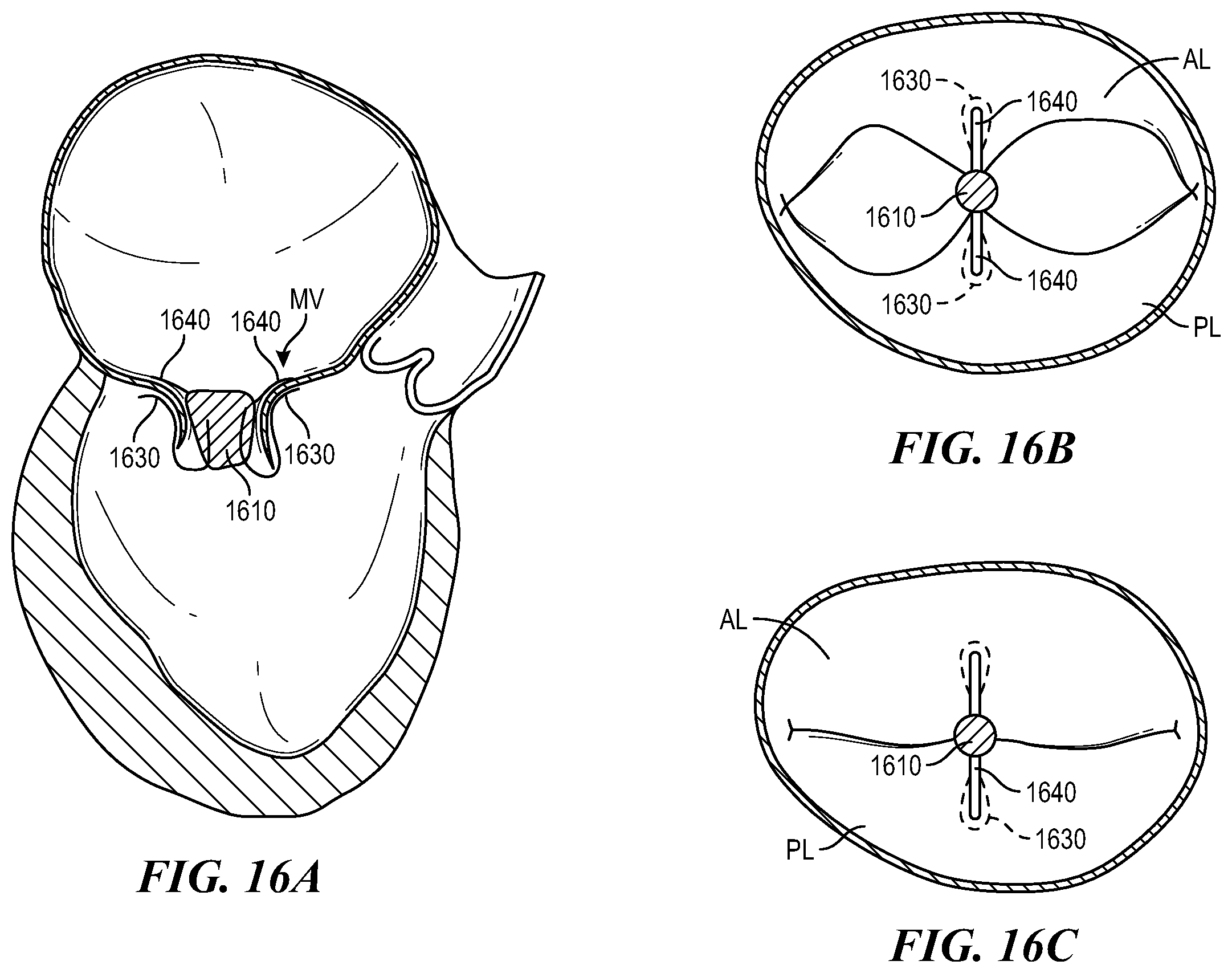 Patent US12588996 Figure 19 – Cardiac valve repair devices and associated systems and methods