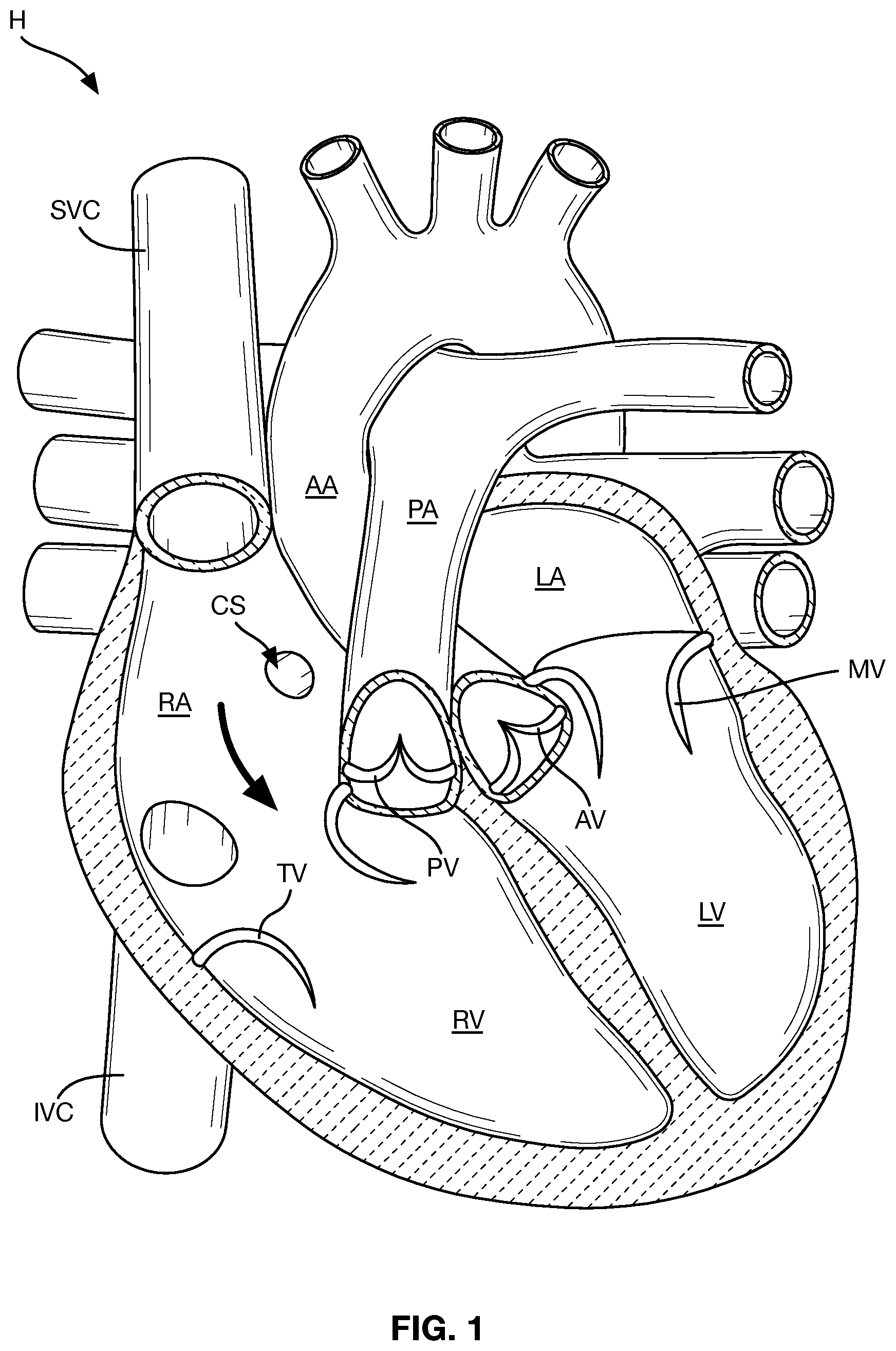 Patent US12588997 Figure 1 – Heart valve sealing devices and delivery devices therefor