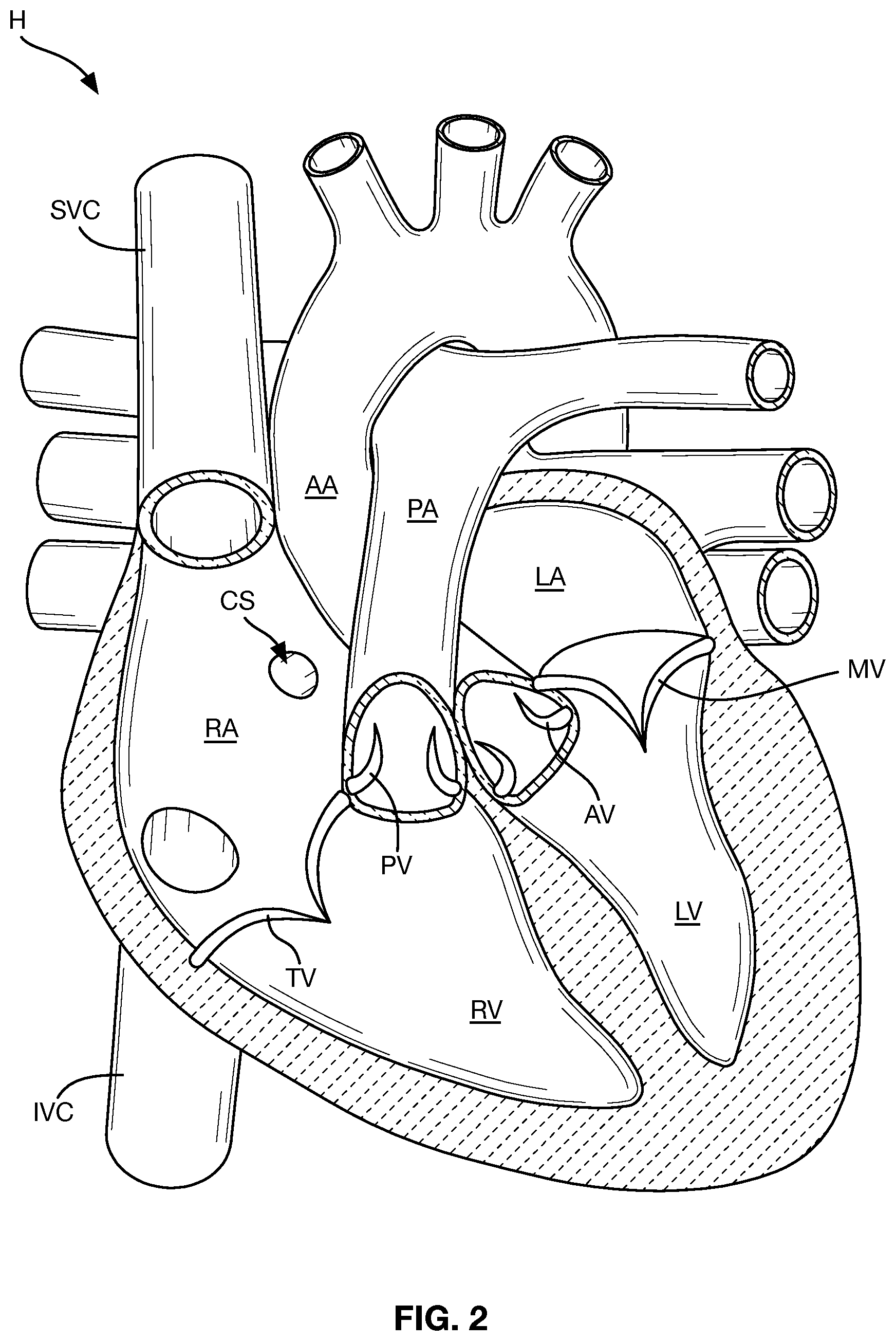 Patent US12588997 Figure 2 – Heart valve sealing devices and delivery devices therefor