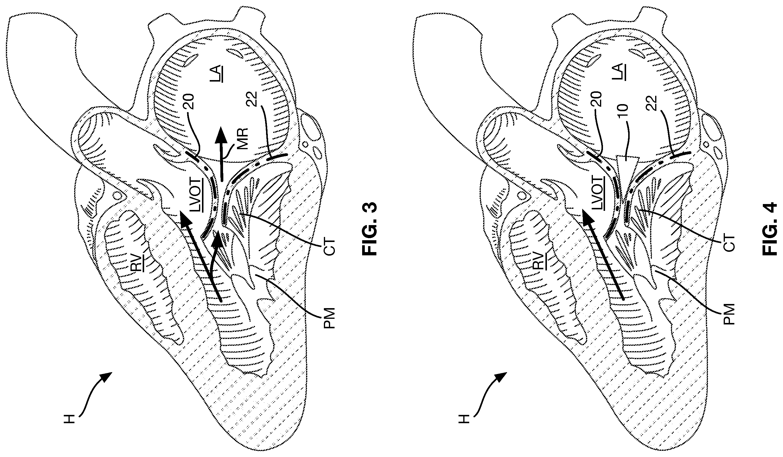 Patent US12588997 Figure 3 – Heart valve sealing devices and delivery devices therefor