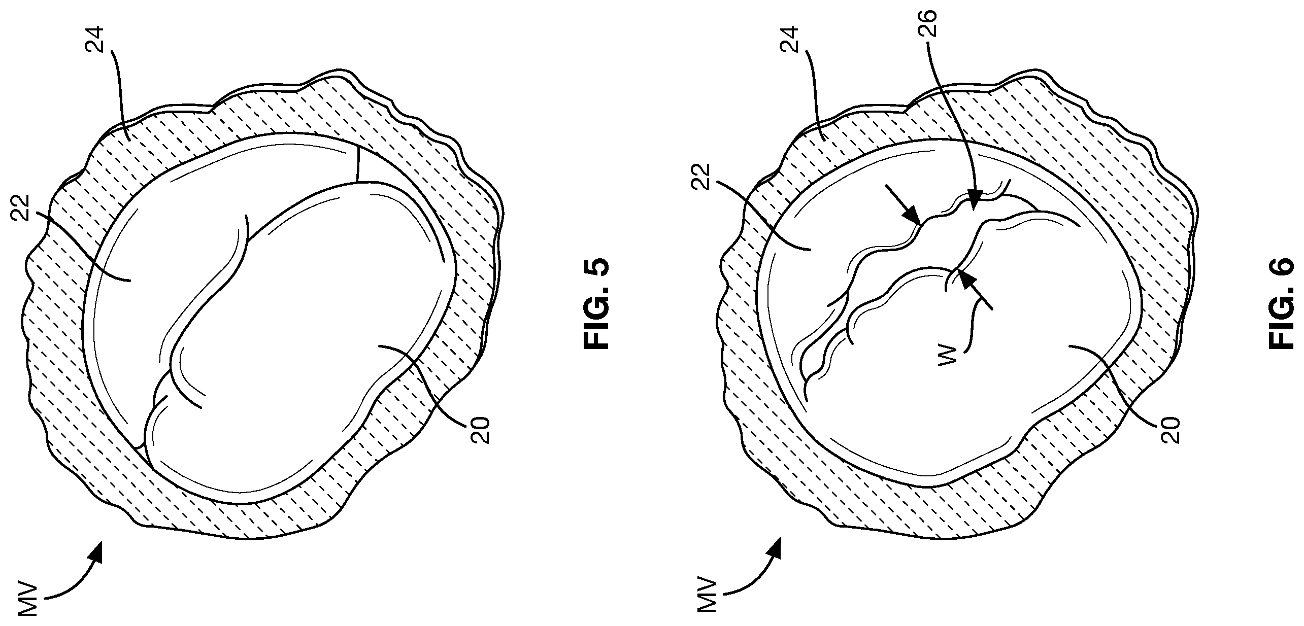 Patent US12588997 Figure 4 – Heart valve sealing devices and delivery devices therefor