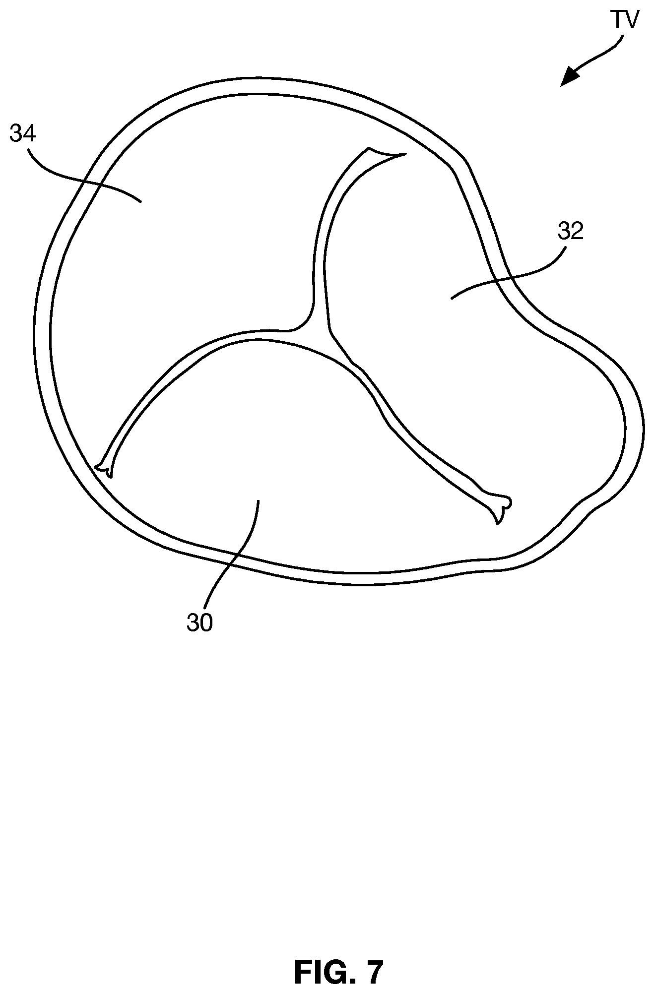 Patent US12588997 Figure 5 – Heart valve sealing devices and delivery devices therefor