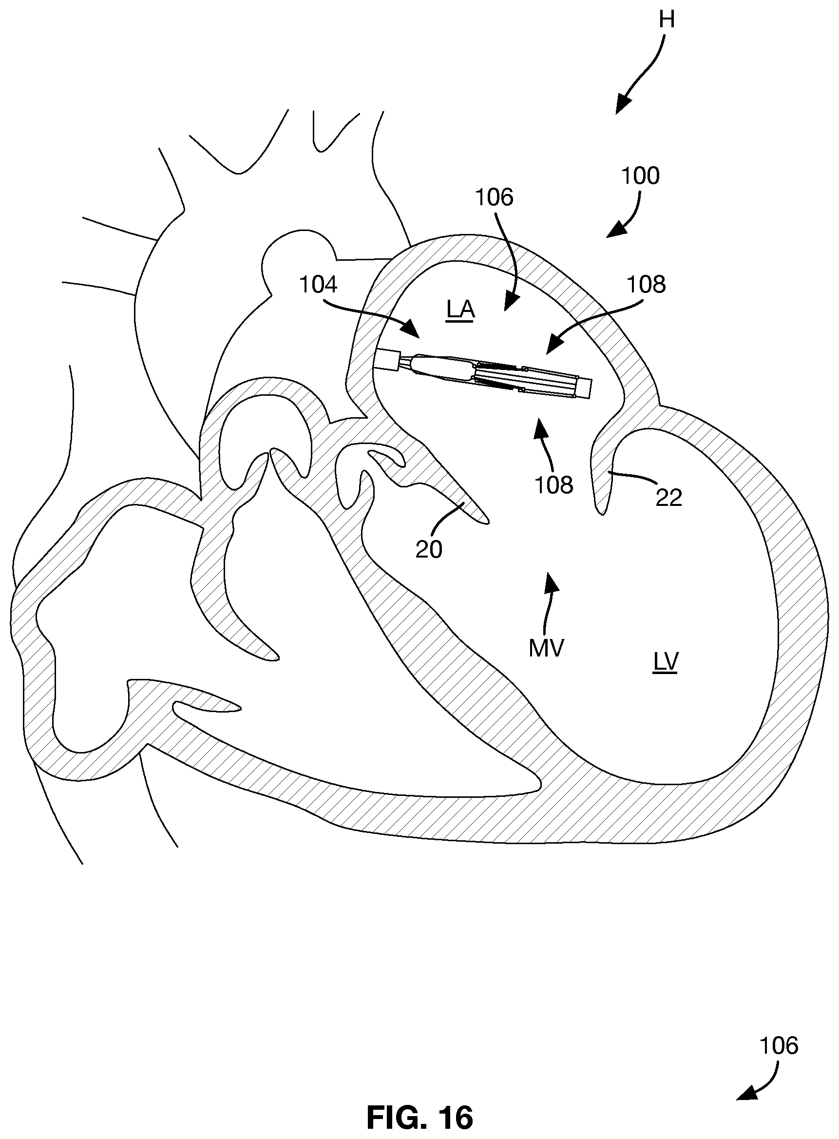 Patent US12588997 Figure 8 – Heart valve sealing devices and delivery devices therefor
