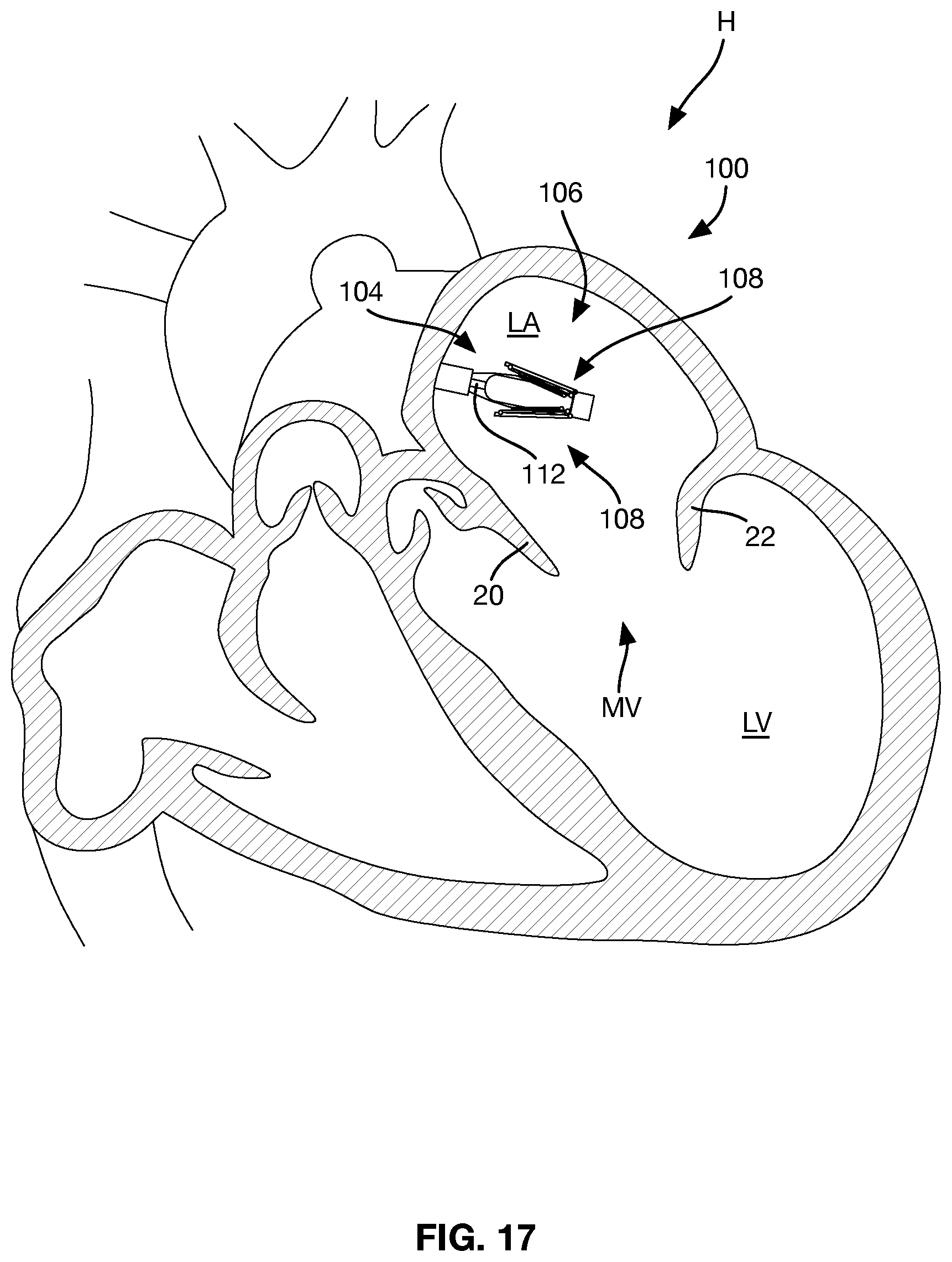 Patent US12588997 Figure 9 – Heart valve sealing devices and delivery devices therefor