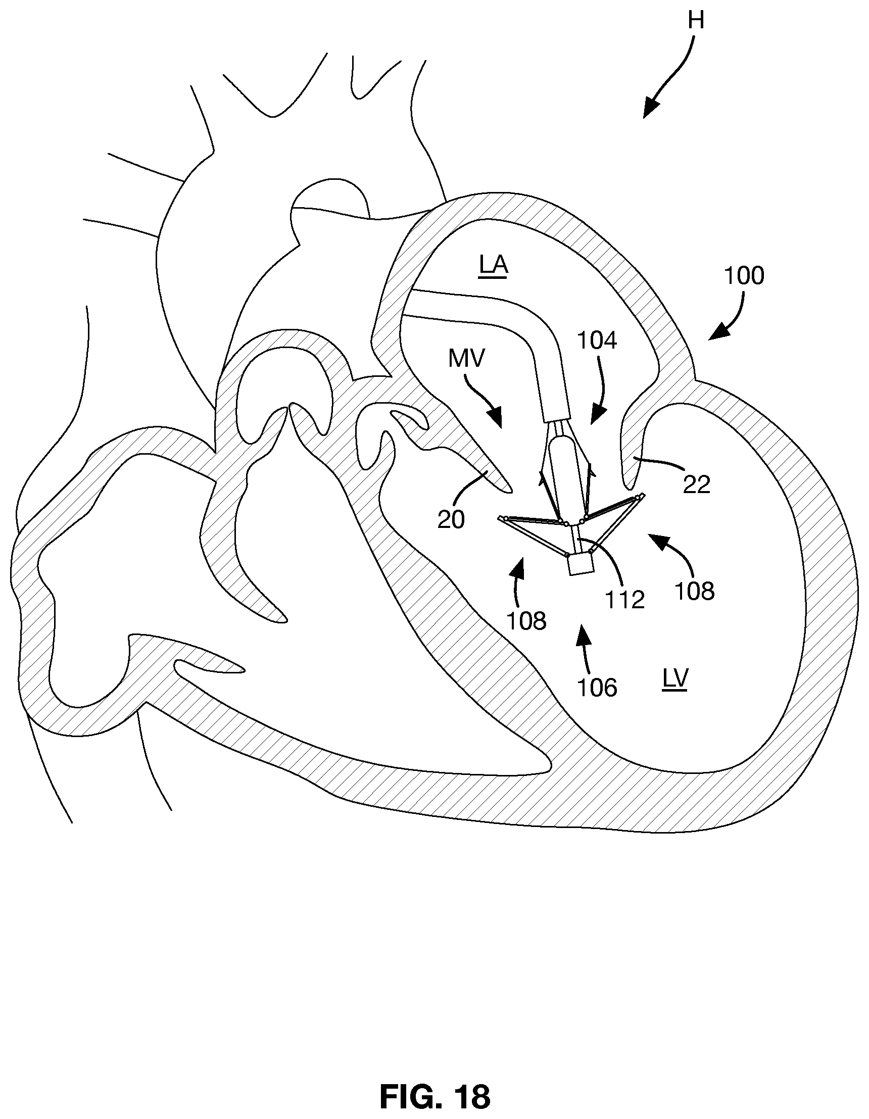 Patent US12588997 Figure 10 – Heart valve sealing devices and delivery devices therefor
