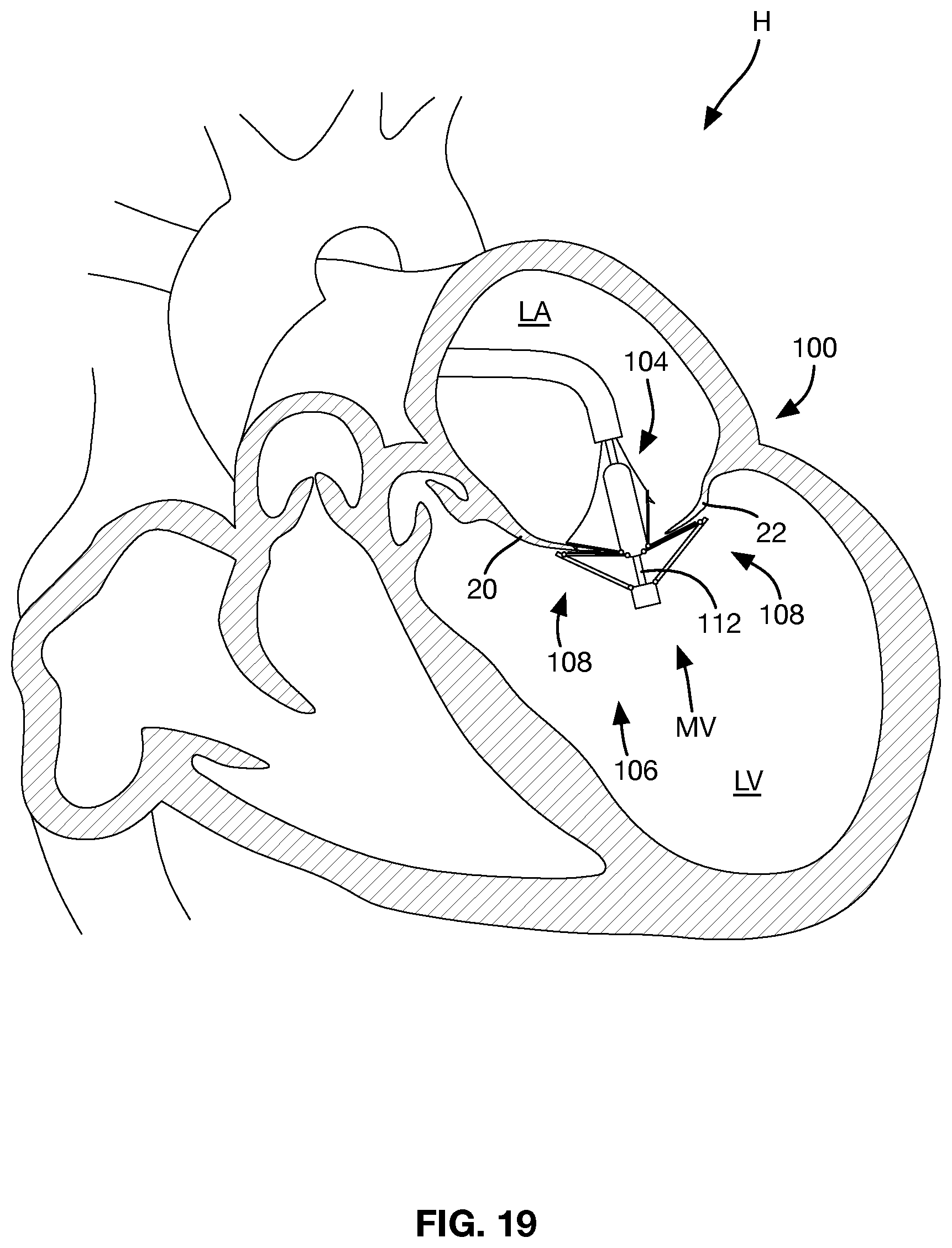Patent US12588997 Figure 11 – Heart valve sealing devices and delivery devices therefor