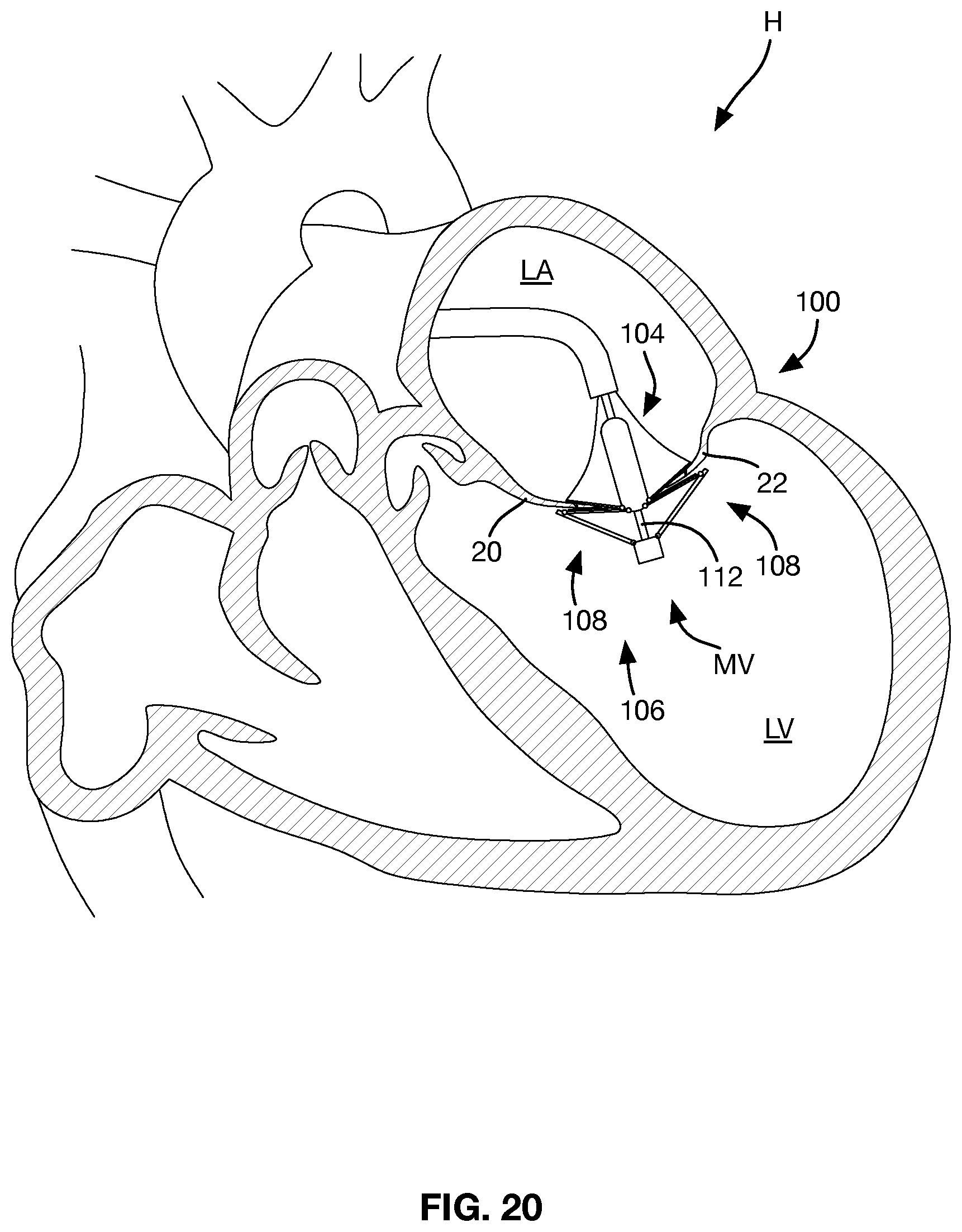 Patent US12588997 Figure 12 – Heart valve sealing devices and delivery devices therefor