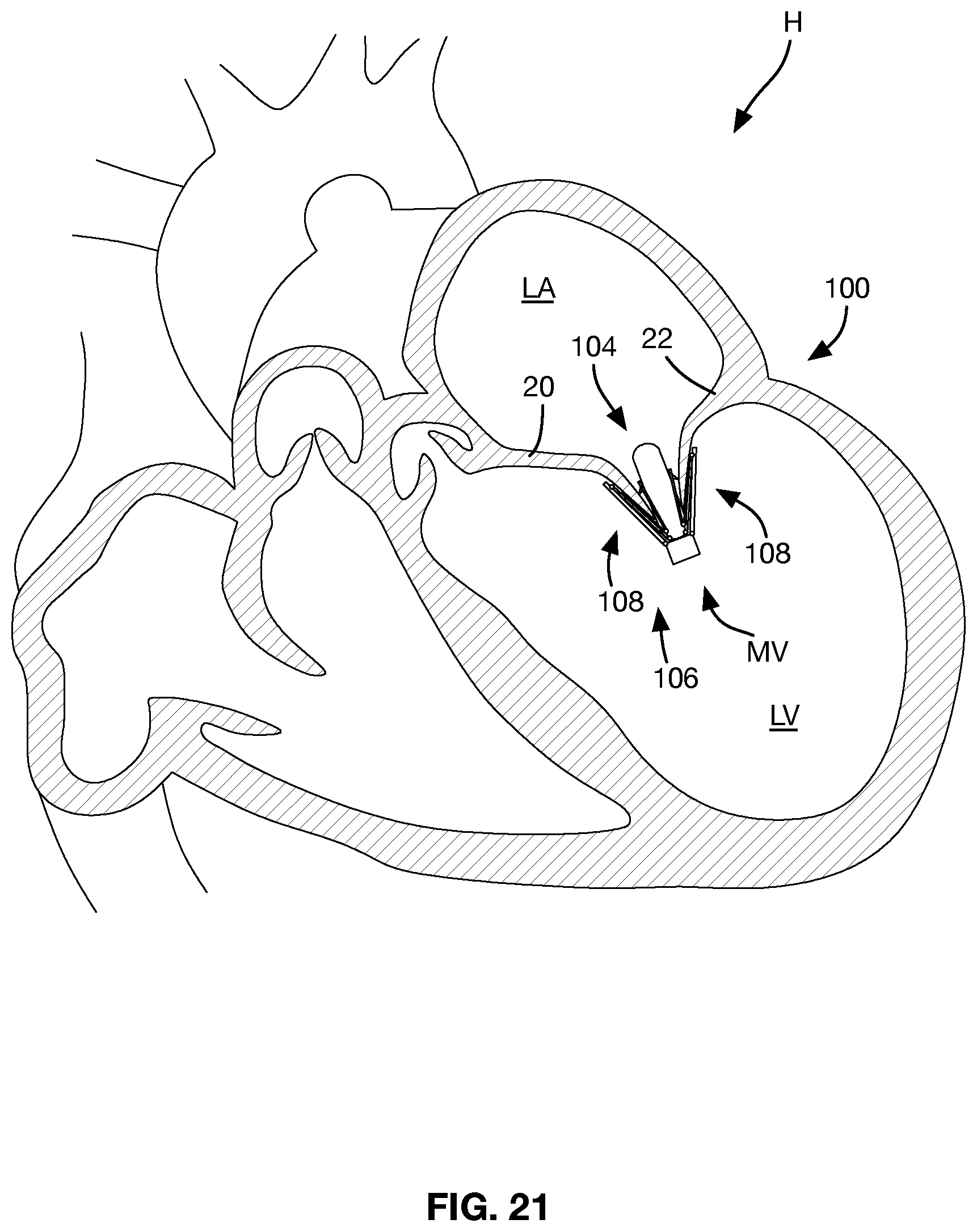 Patent US12588997 Figure 13 – Heart valve sealing devices and delivery devices therefor