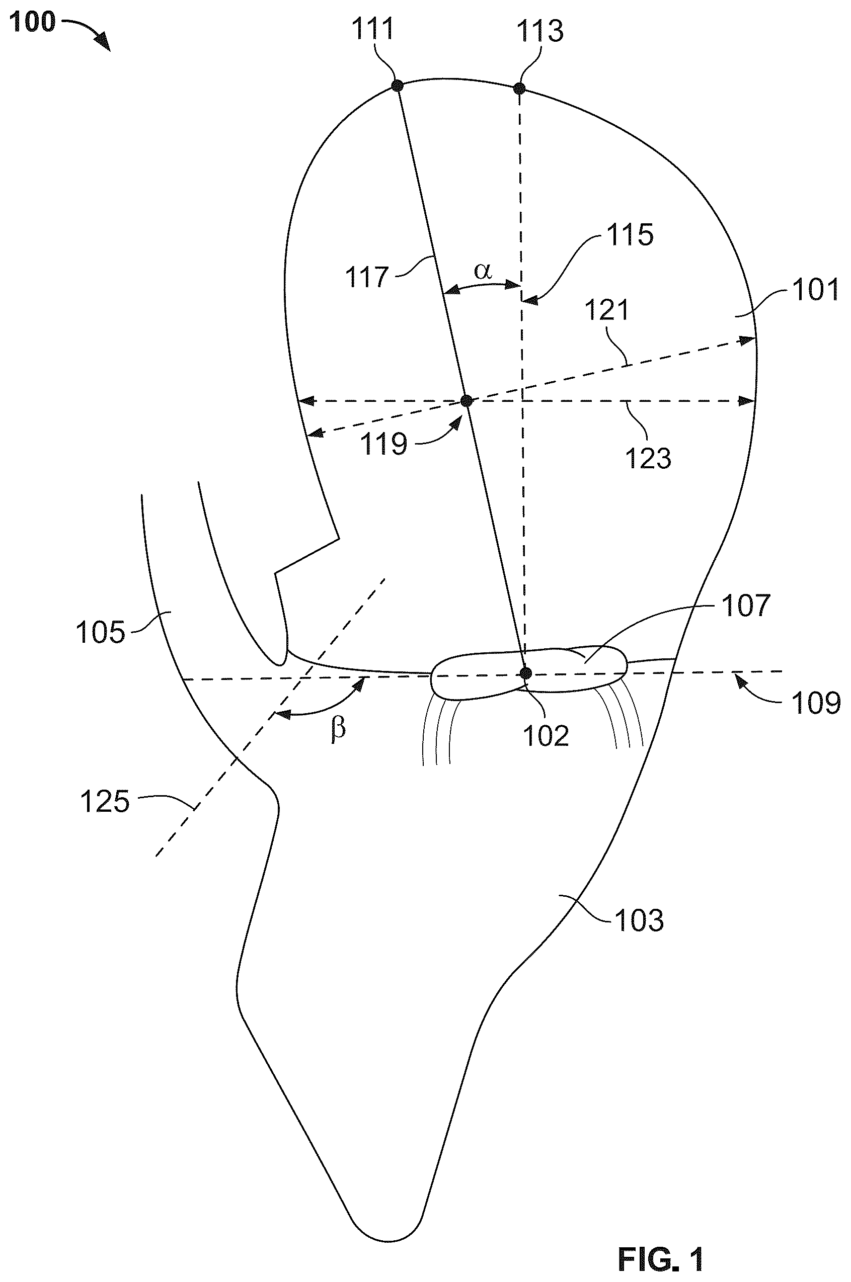 Patent US12588998 Figure 1 – Prosthetic heart valve for natural blood flow