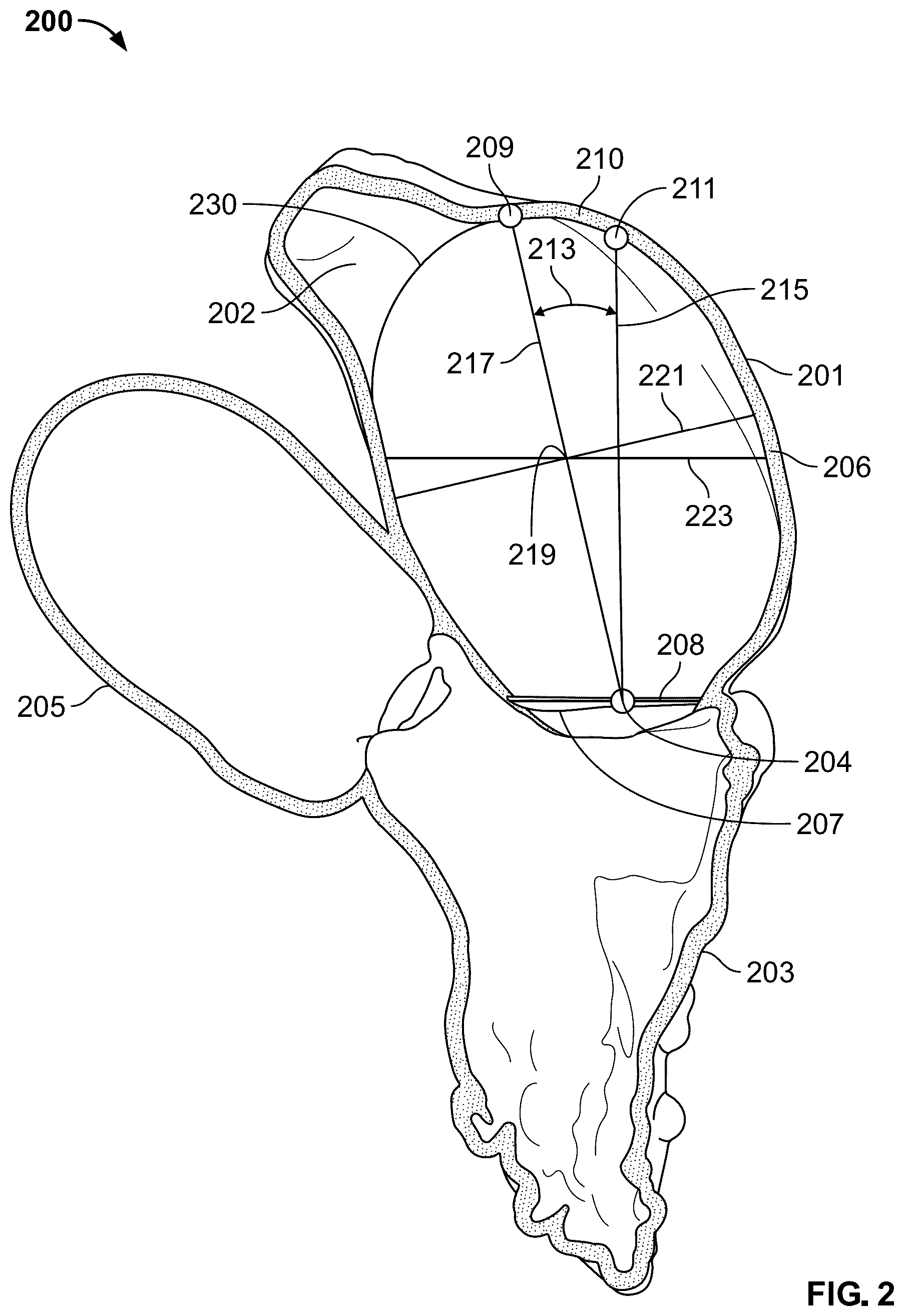 Patent US12588998 Figure 2 – Prosthetic heart valve for natural blood flow