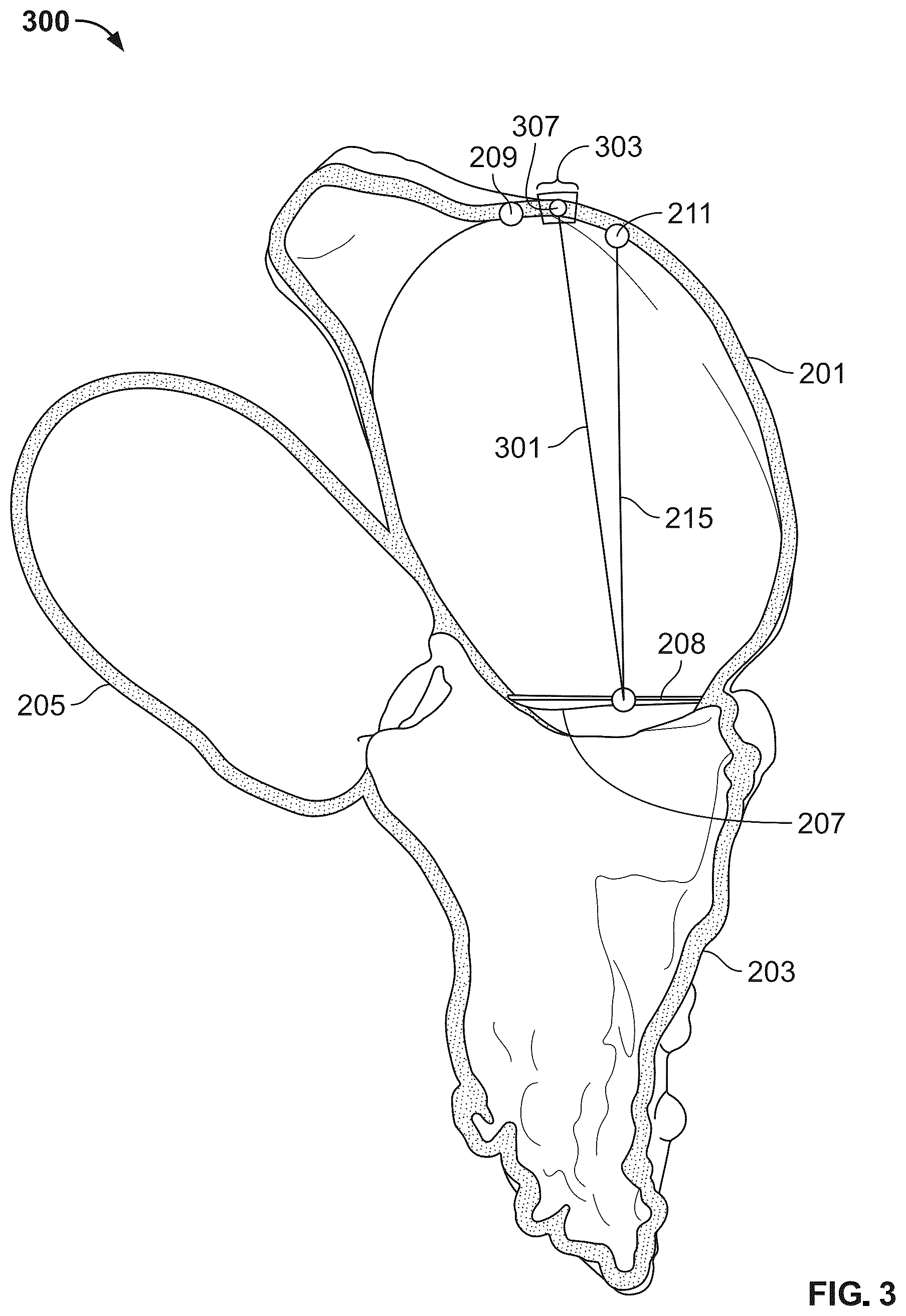 Patent US12588998 Figure 3 – Prosthetic heart valve for natural blood flow