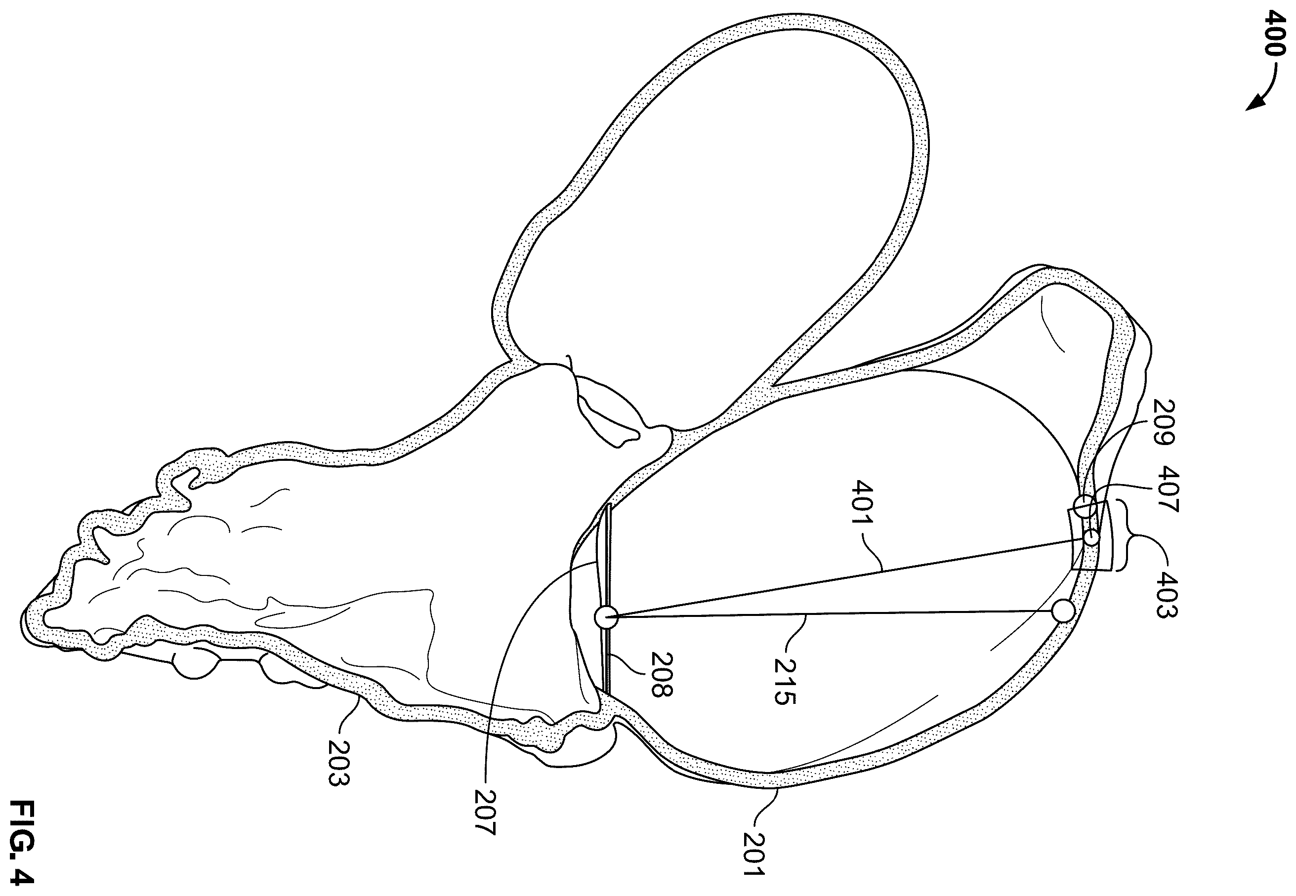 Patent US12588998 Figure 4 – Prosthetic heart valve for natural blood flow