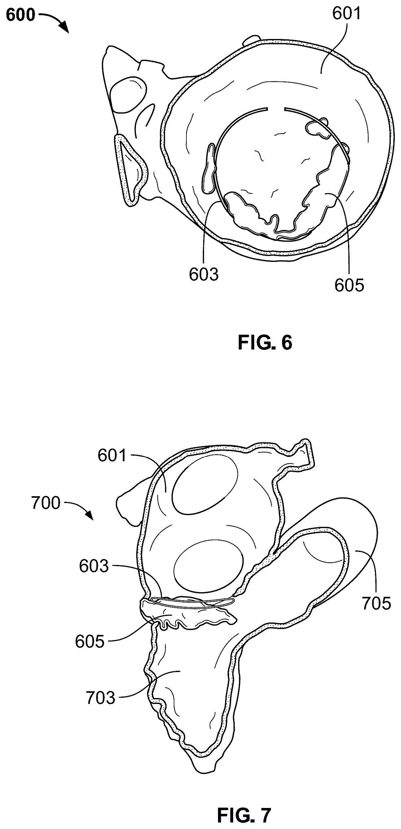 Patent US12588998 Figure 6 – Prosthetic heart valve for natural blood flow