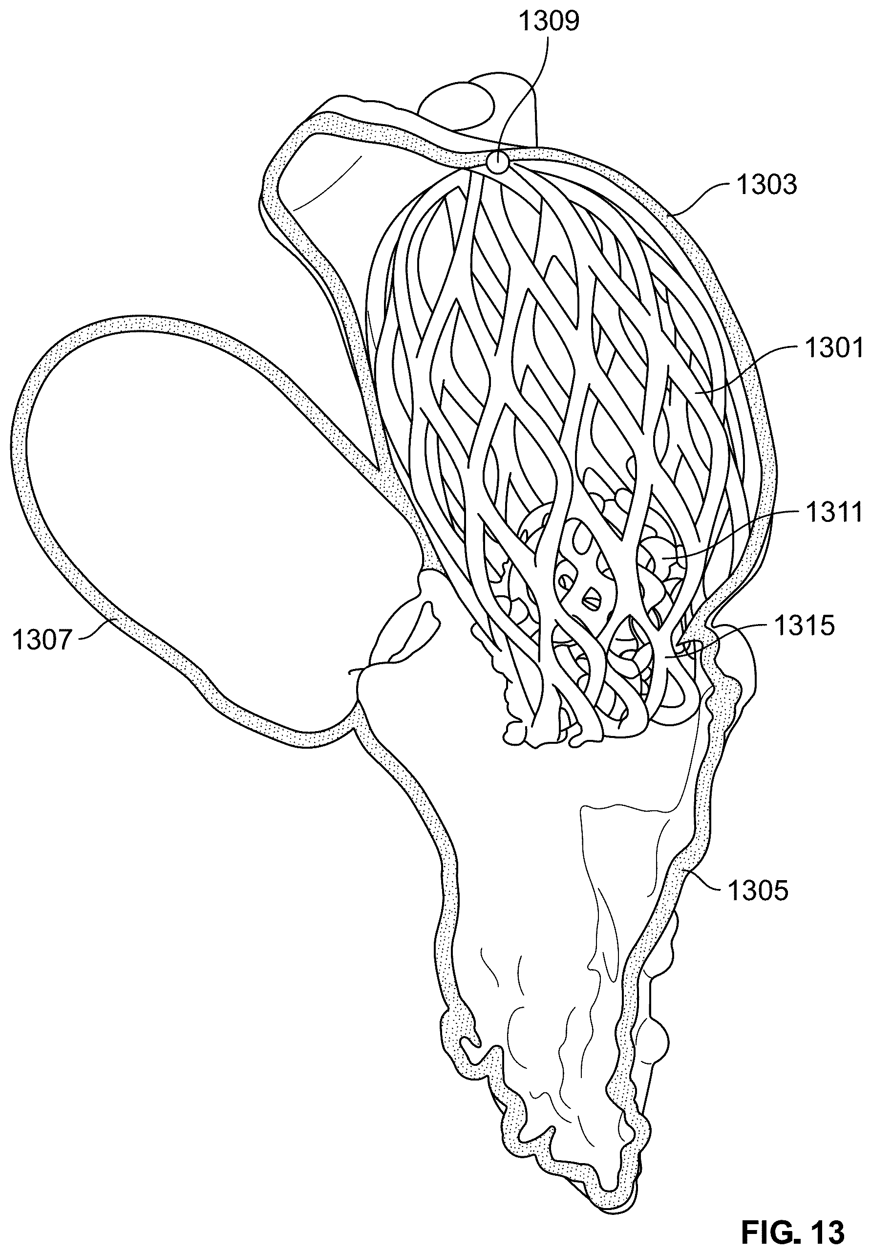 Patent US12588998 Figure 14 – Prosthetic heart valve for natural blood flow