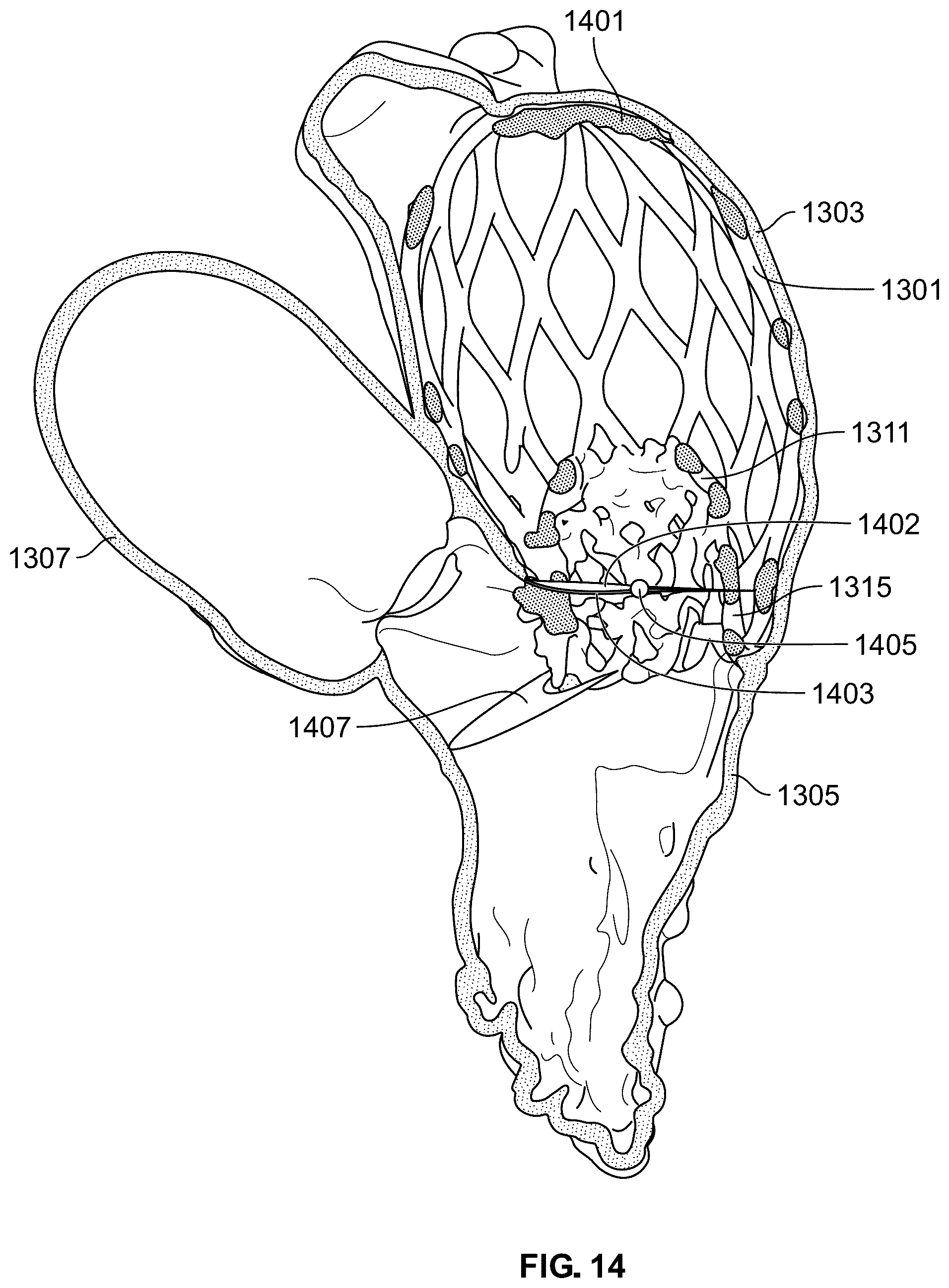 Patent US12588998 Figure 15 – Prosthetic heart valve for natural blood flow