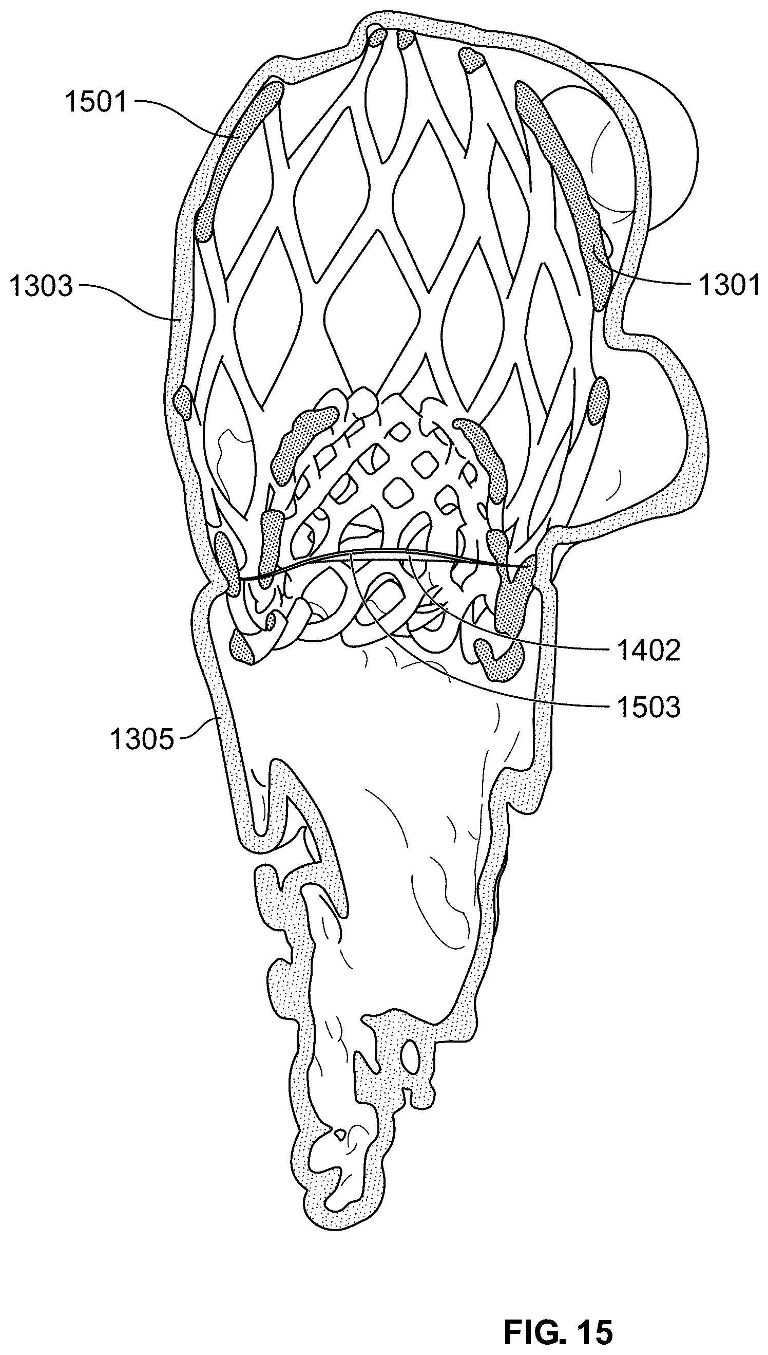 Patent US12588998 Figure 16 – Prosthetic heart valve for natural blood flow