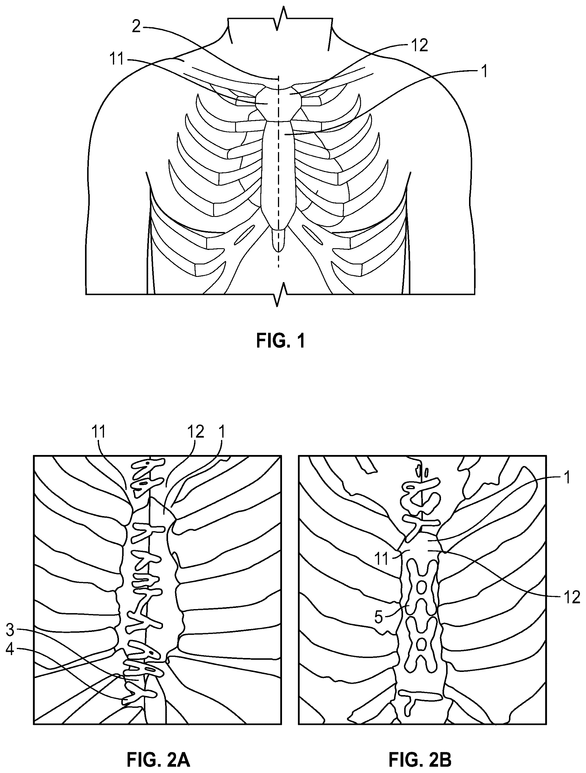 Patent US12588999 Figure 1 – System and method to fuse bone
