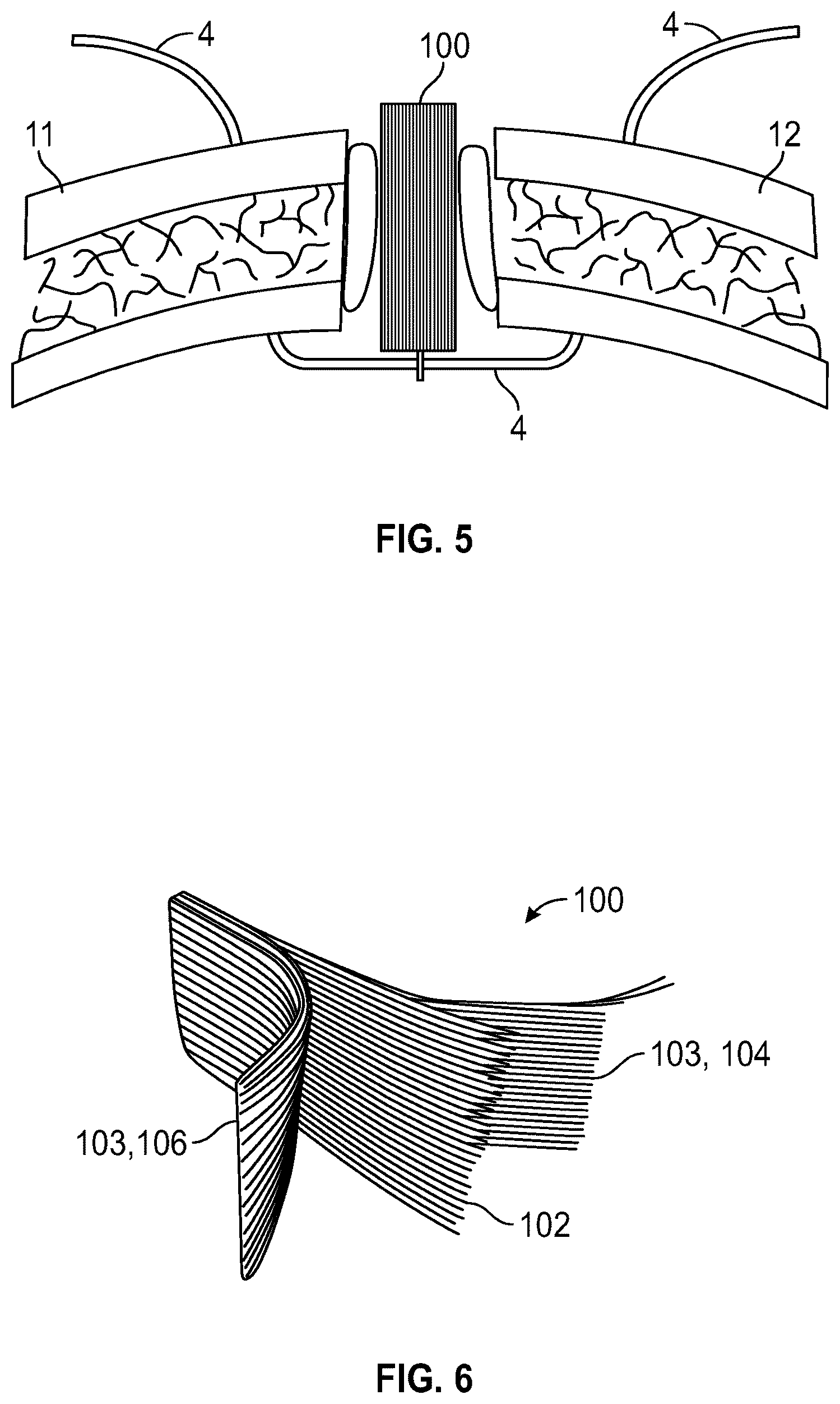 Patent US12588999 Figure 3 – System and method to fuse bone