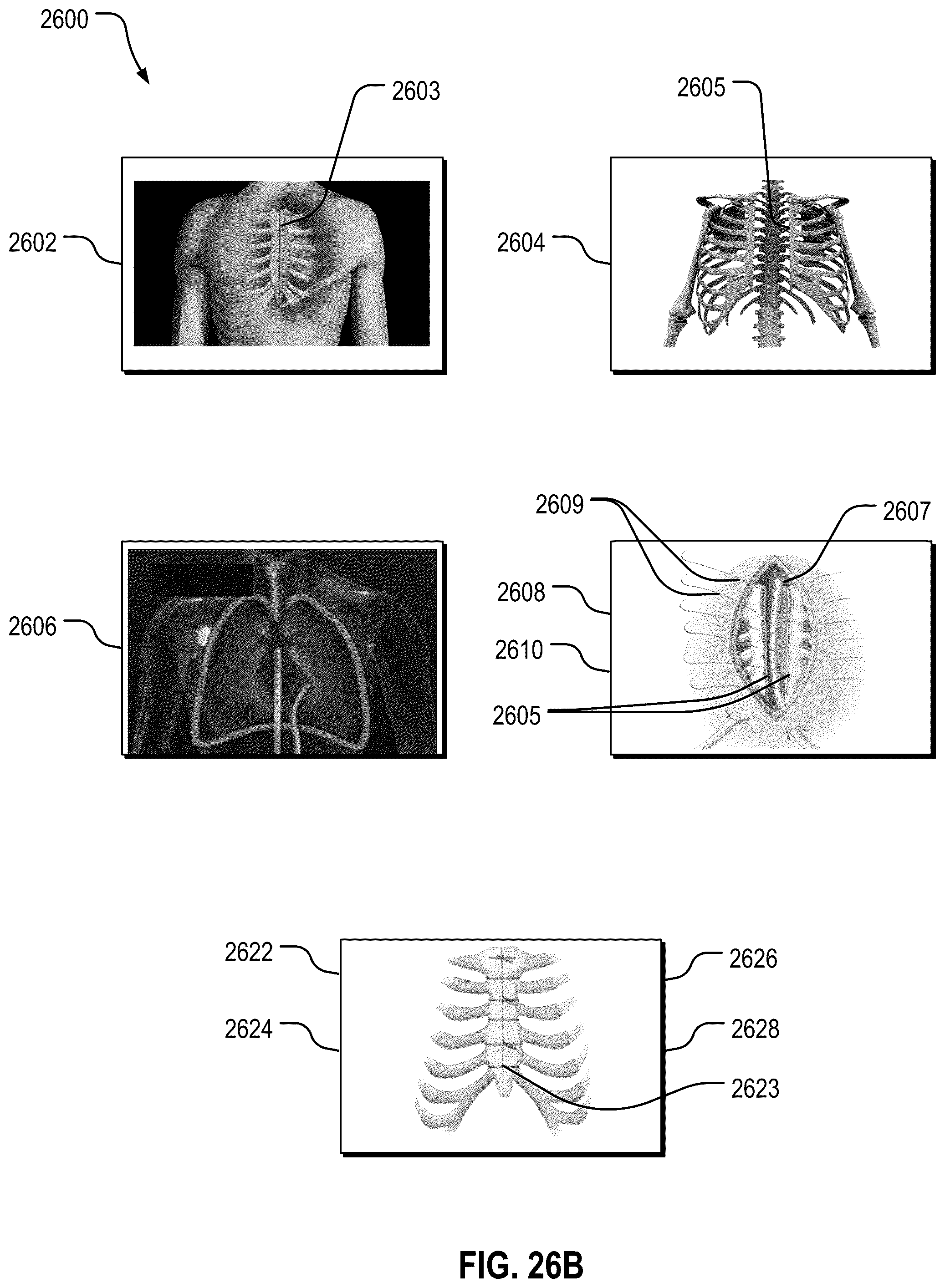 Patent US12588999 Figure 20 – System and method to fuse bone