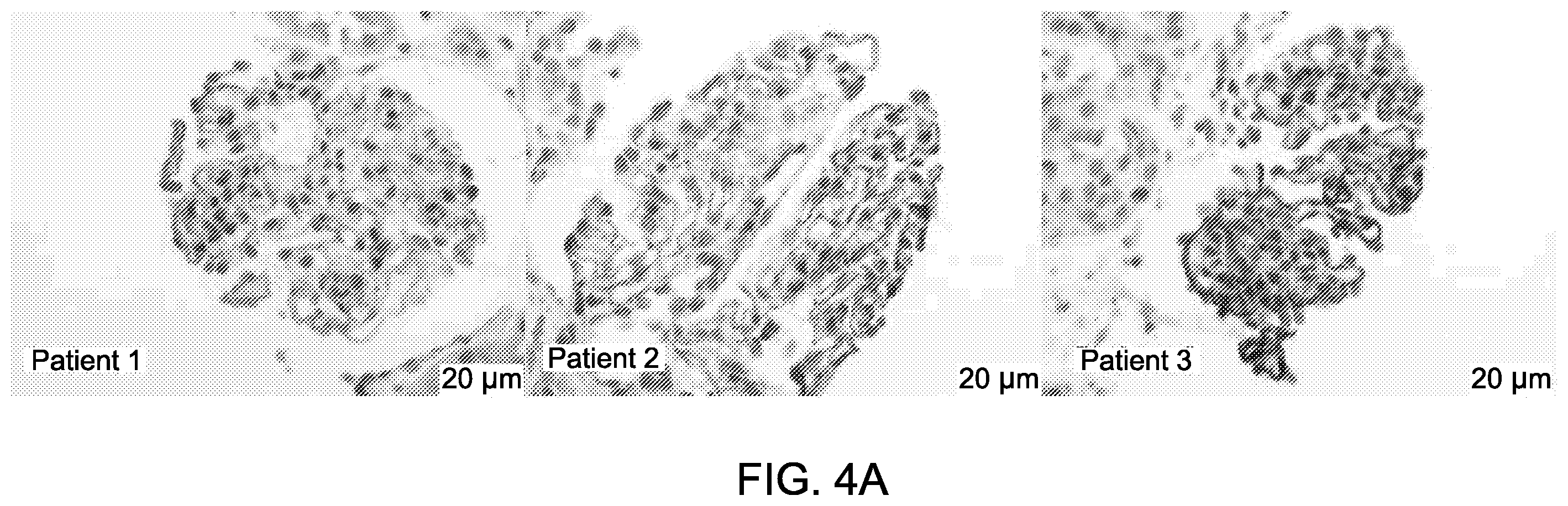 Patent US12590165 Figure 5 – Methods and materials for identifying and treating membranous nephropathy based on elevated Semaphorin 3B