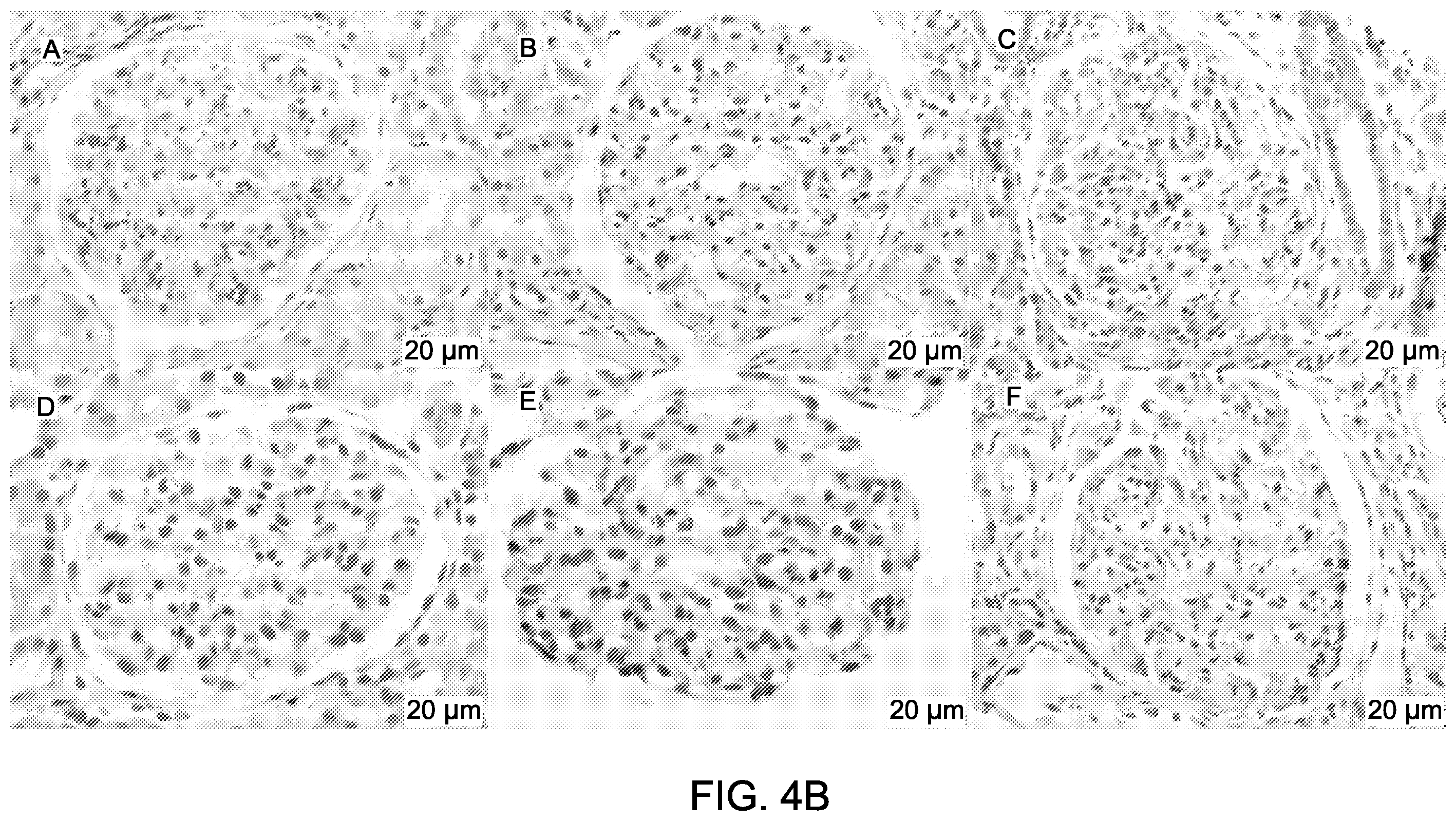 Patent US12590165 Figure 6 – Methods and materials for identifying and treating membranous nephropathy based on elevated Semaphorin 3B