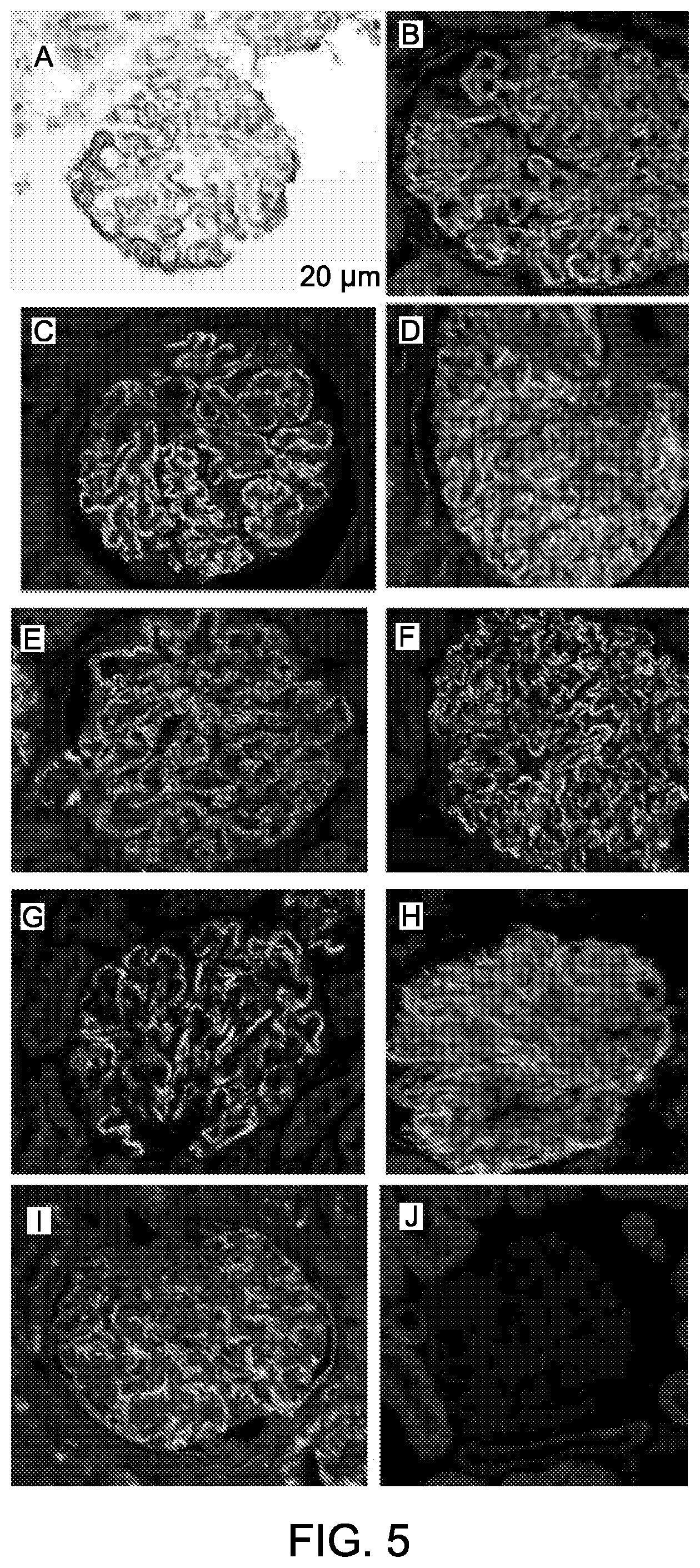 Patent US12590165 Figure 7 – Methods and materials for identifying and treating membranous nephropathy based on elevated Semaphorin 3B