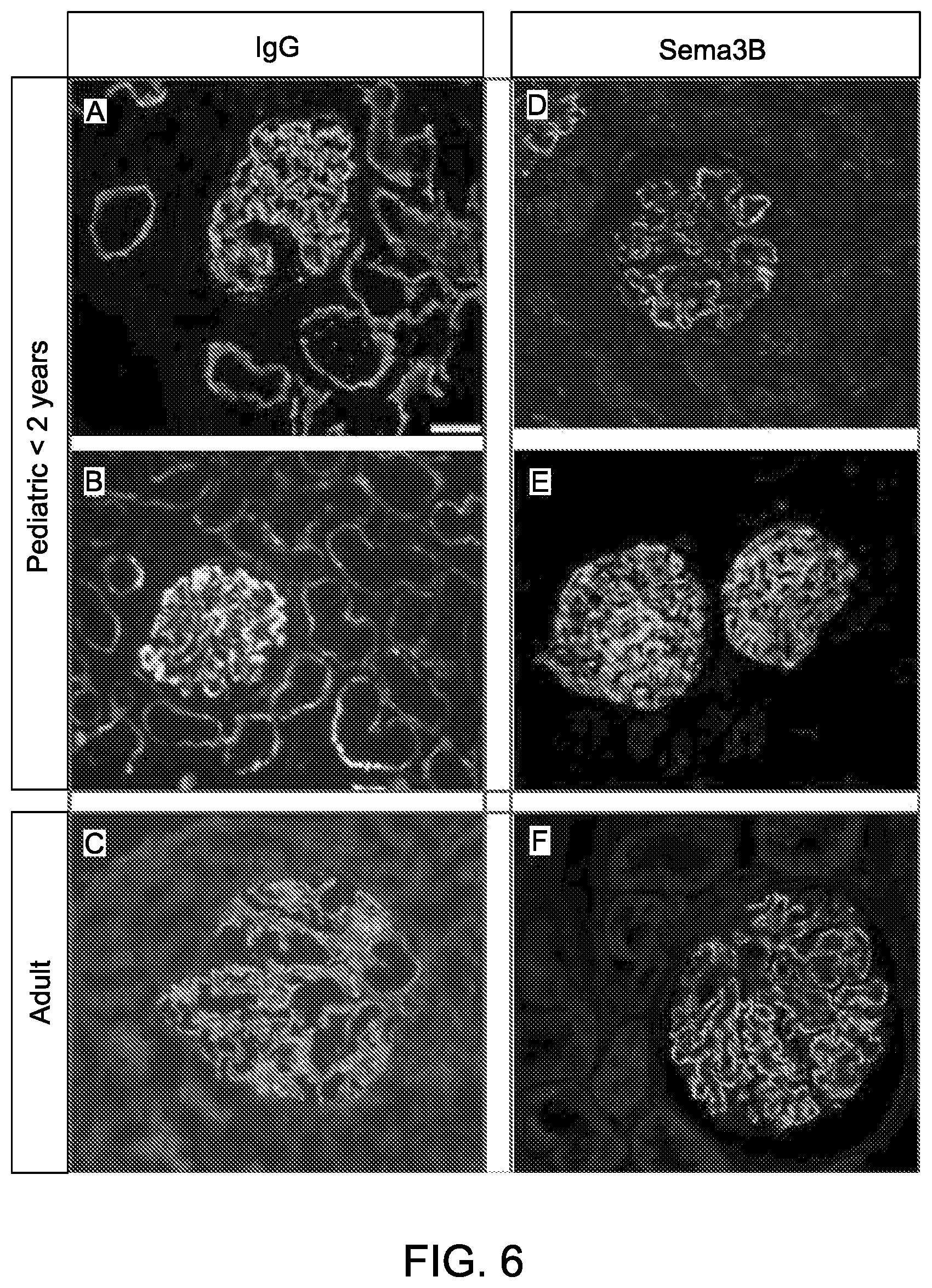 Patent US12590165 Figure 8 – Methods and materials for identifying and treating membranous nephropathy based on elevated Semaphorin 3B