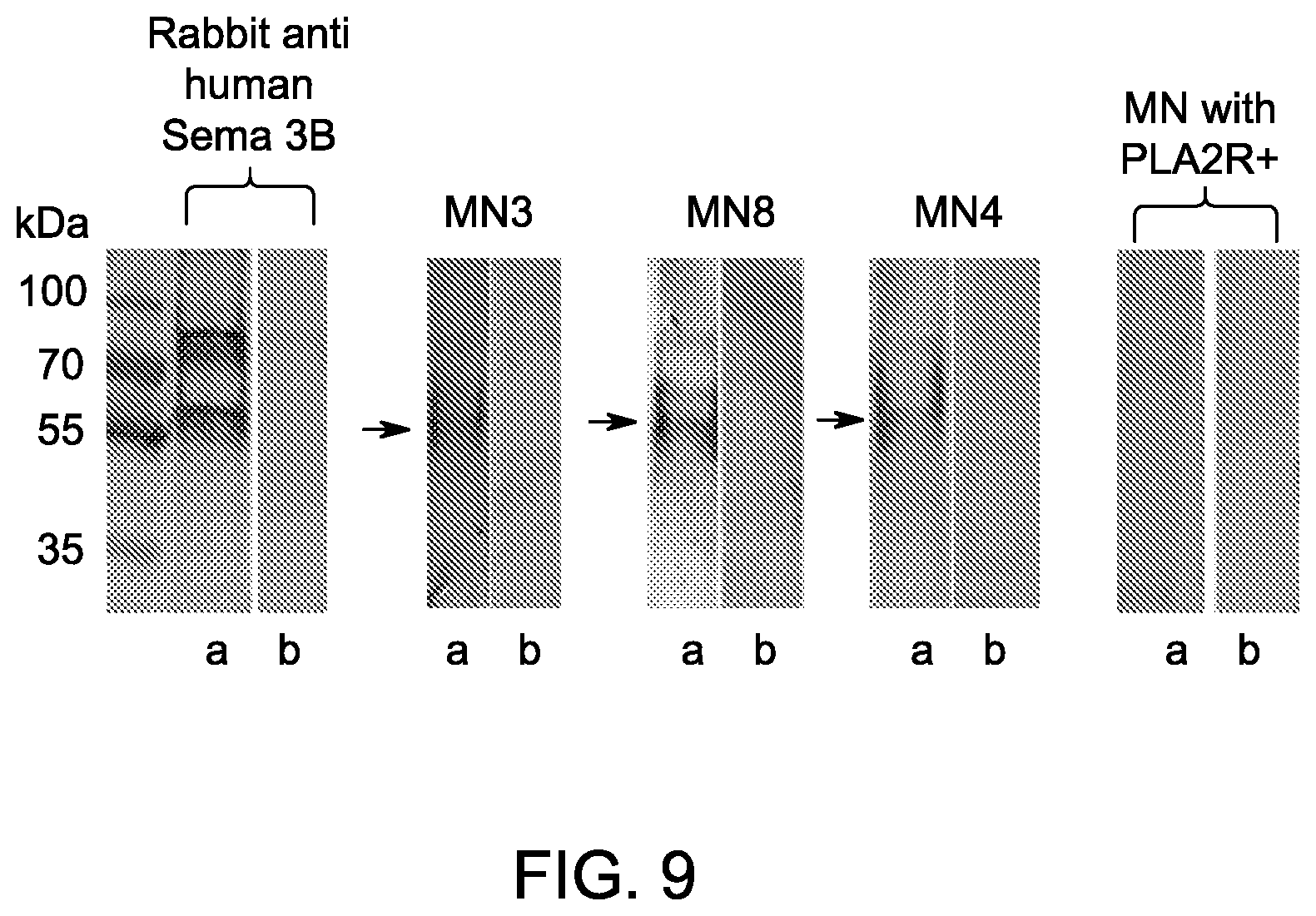 Patent US12590165 Figure 11 – Methods and materials for identifying and treating membranous nephropathy based on elevated Semaphorin 3B