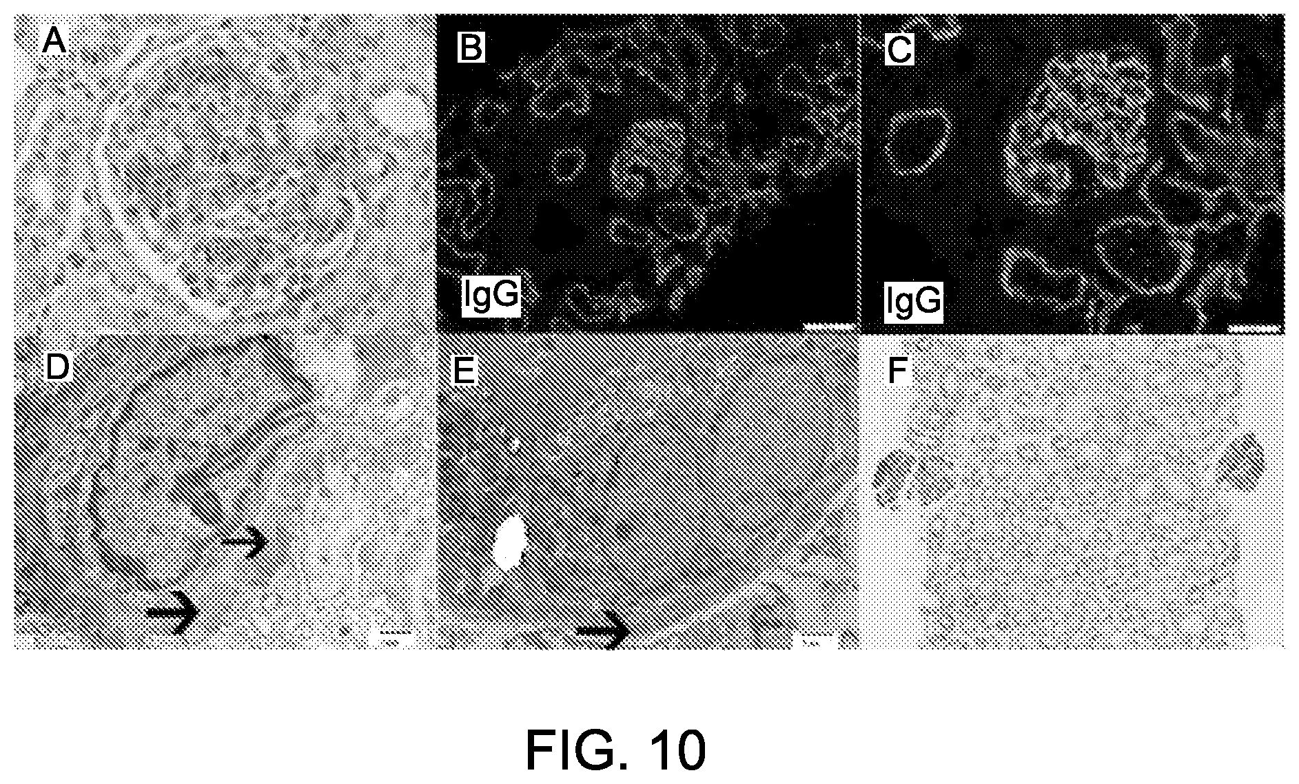 Patent US12590165 Figure 12 – Methods and materials for identifying and treating membranous nephropathy based on elevated Semaphorin 3B