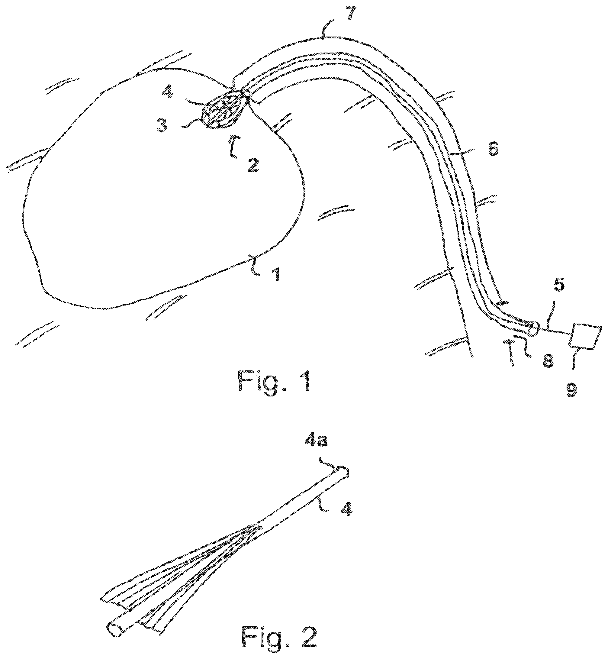 Patent US12590589 — Radially compressible and expandable rotor for a fluid pump — Figure 1