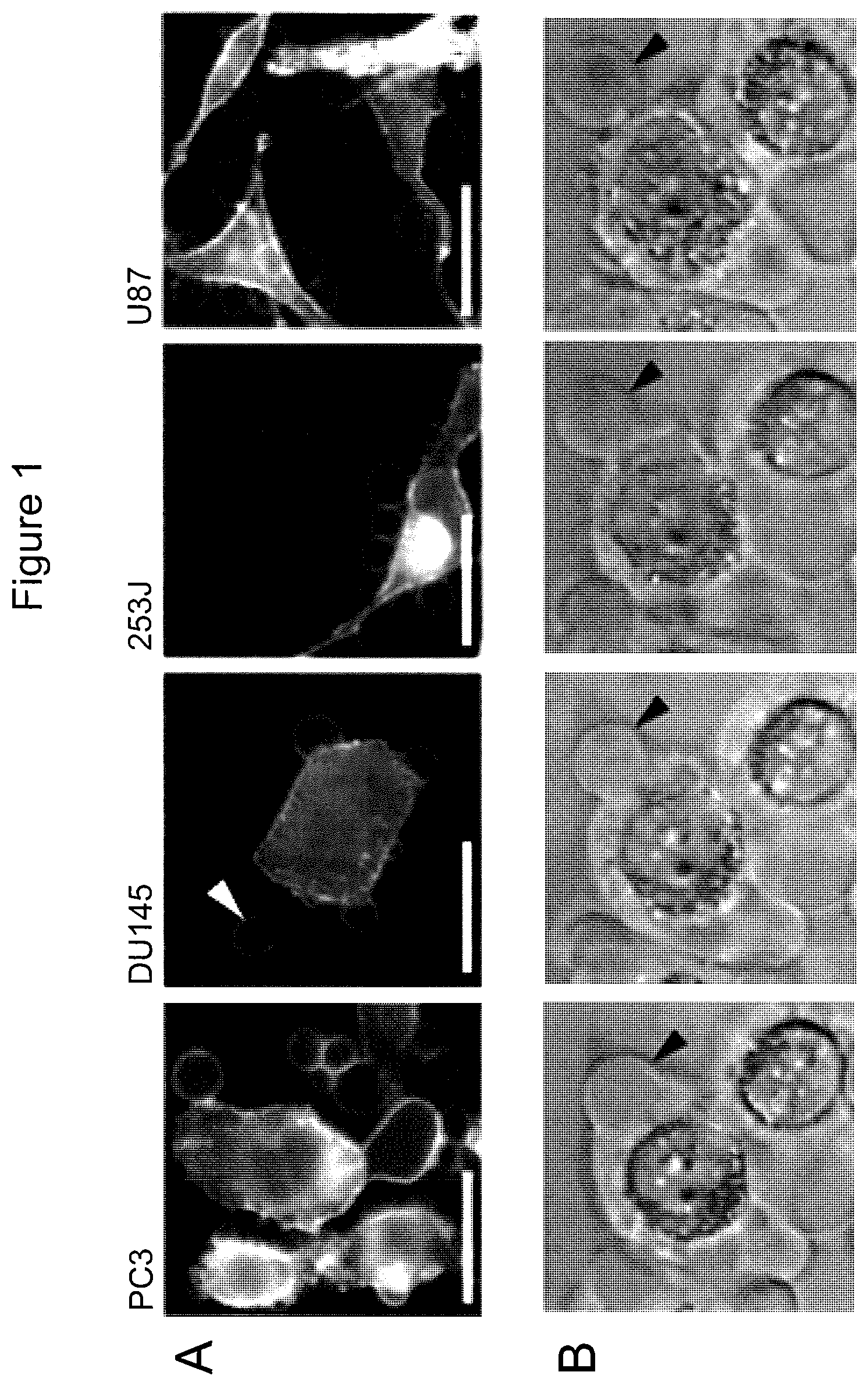 Patent US12590965 Figure 1 – Palmitoyl protein biomarkers in purified extracellular vesicles for early identification of clinically significant prostate cancer