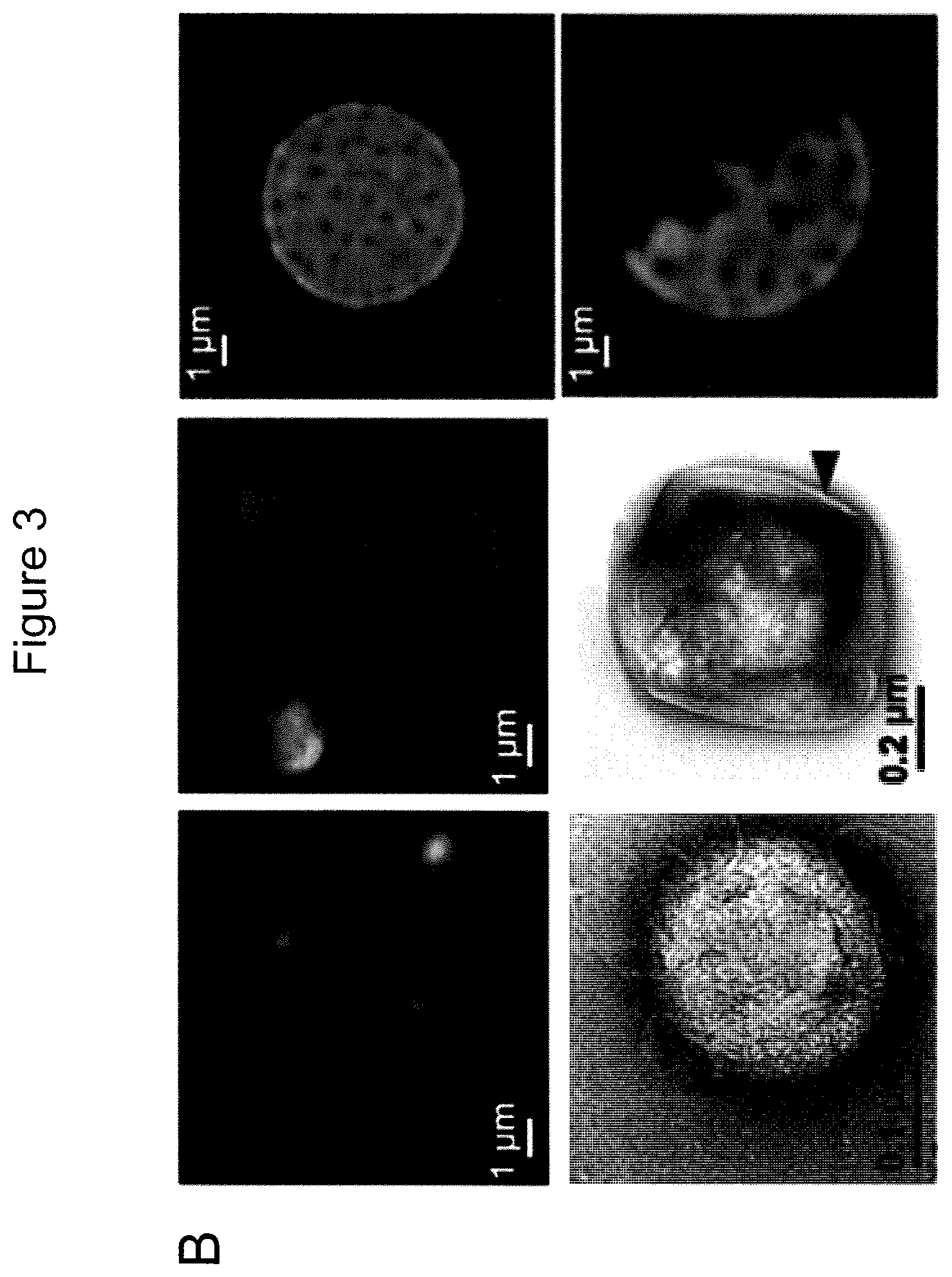 Patent US12590965 Figure 7 – Palmitoyl protein biomarkers in purified extracellular vesicles for early identification of clinically significant prostate cancer