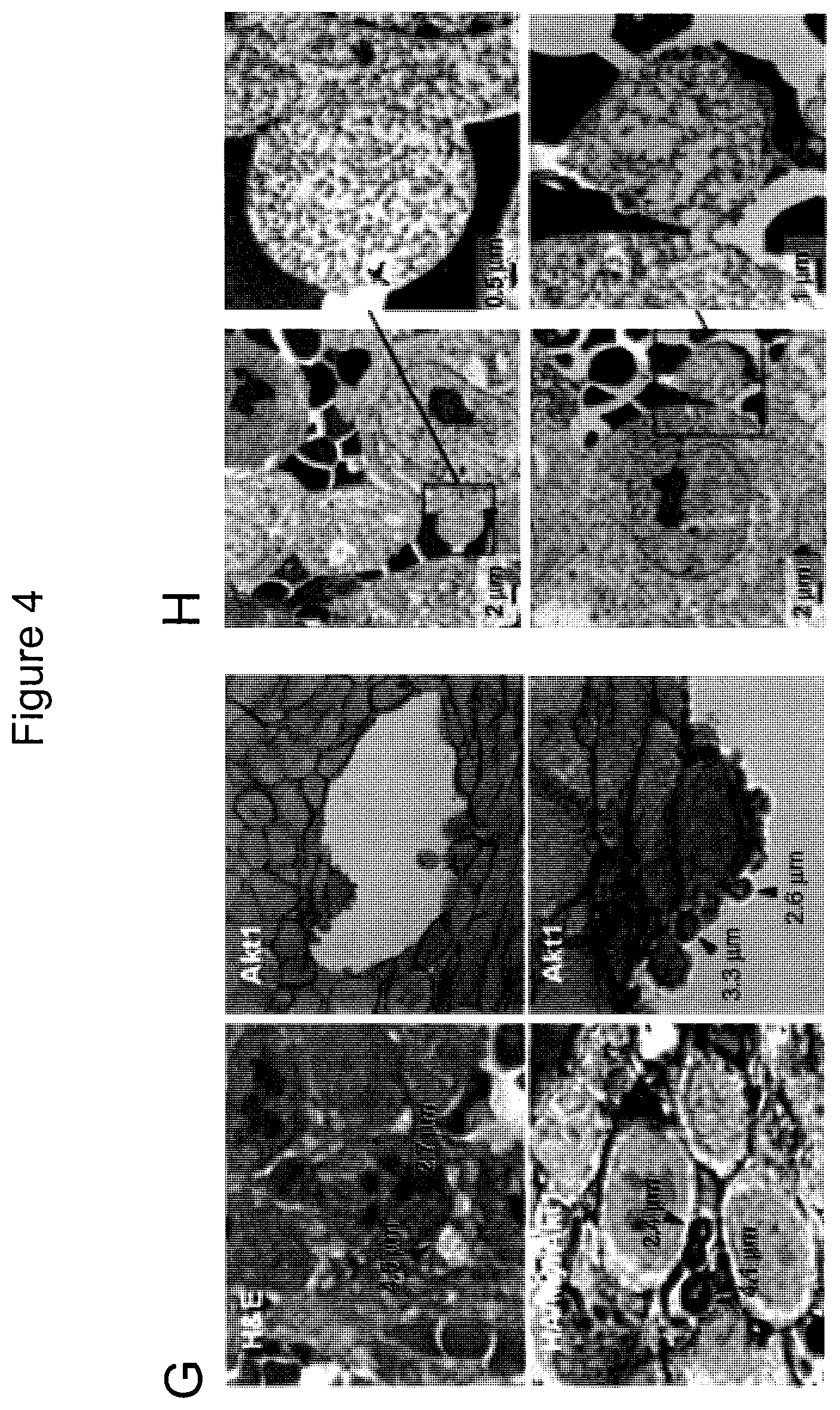 Patent US12590965 Figure 9 – Palmitoyl protein biomarkers in purified extracellular vesicles for early identification of clinically significant prostate cancer