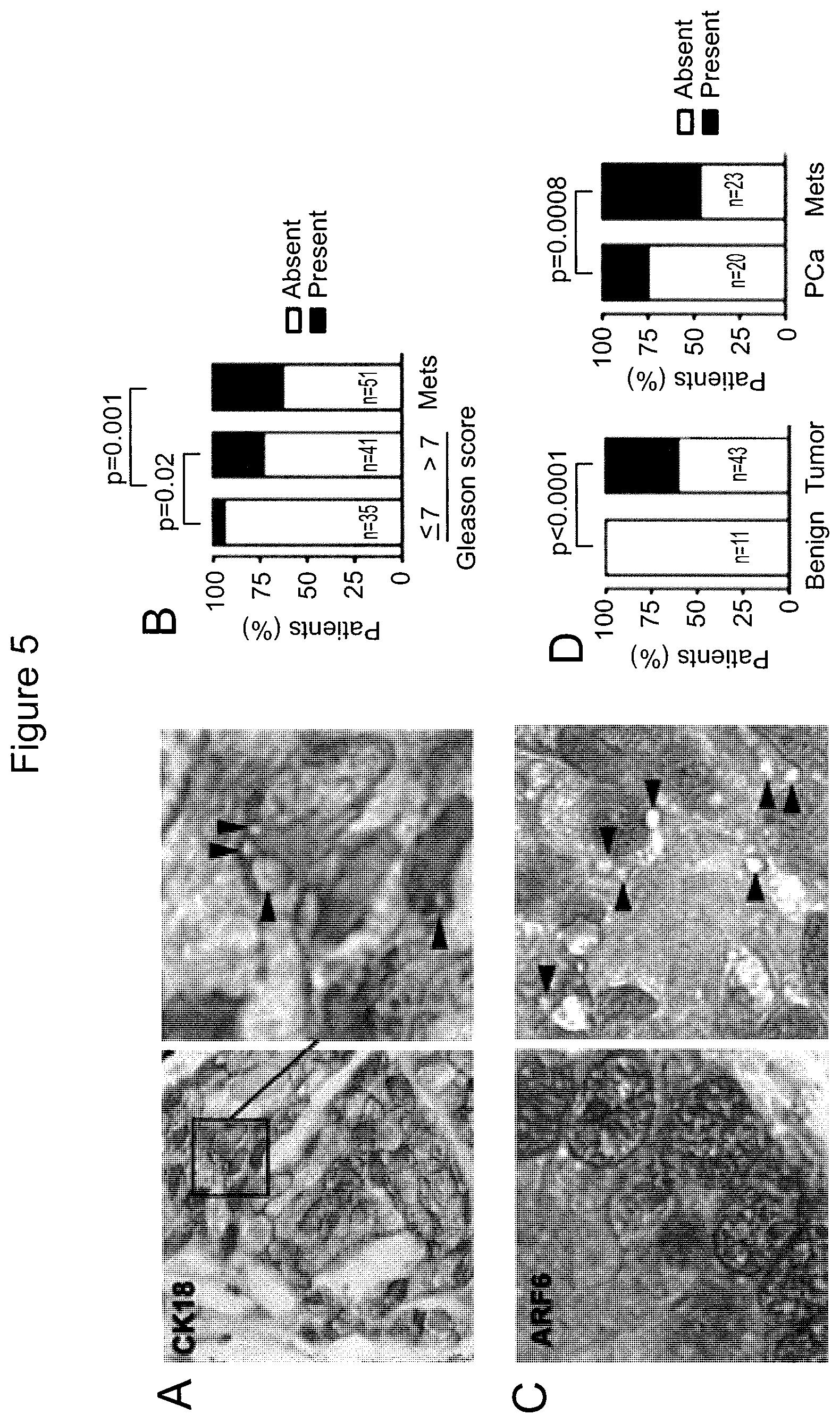 Patent US12590965 Figure 10 – Palmitoyl protein biomarkers in purified extracellular vesicles for early identification of clinically significant prostate cancer