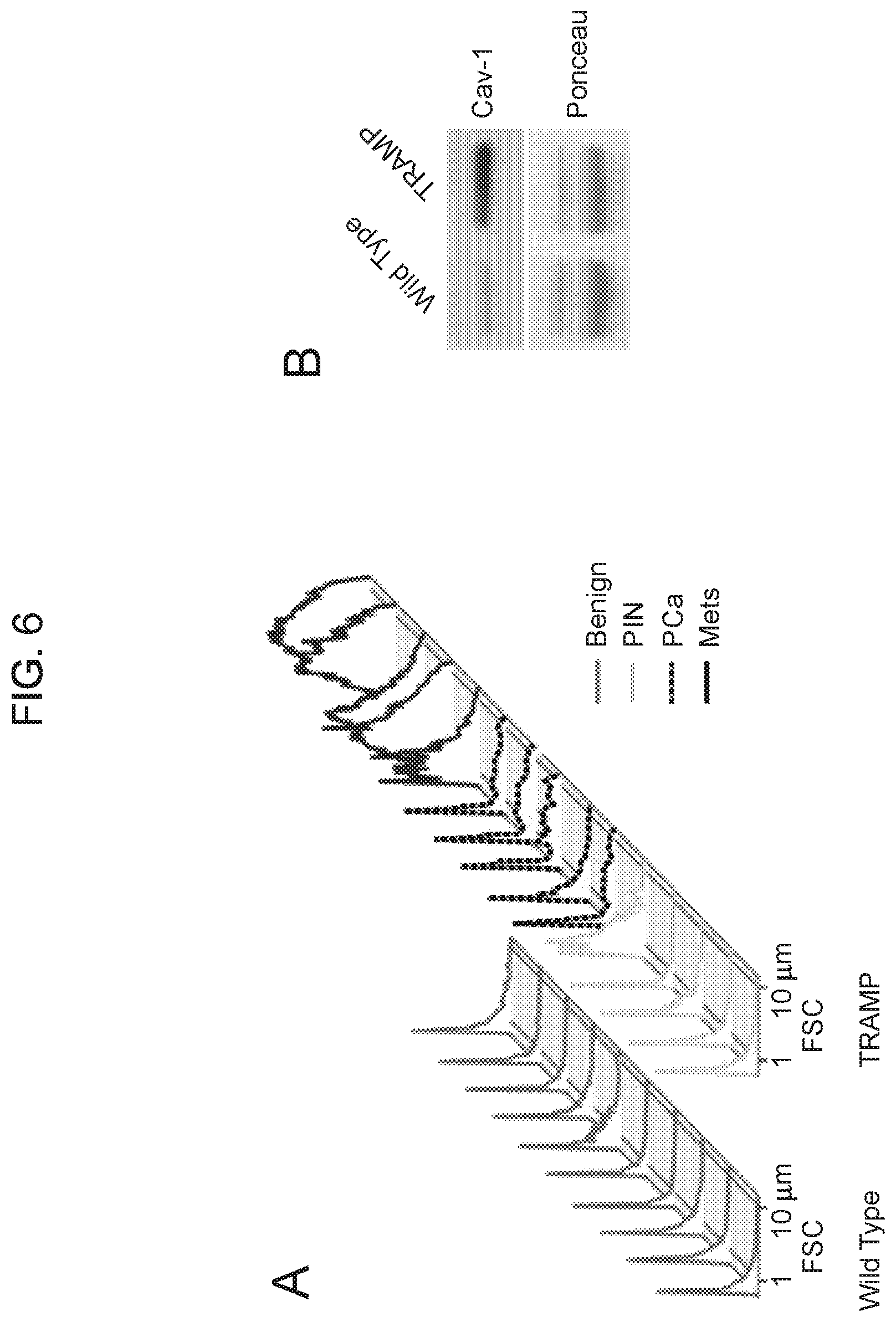 Patent US12590965 Figure 11 – Palmitoyl protein biomarkers in purified extracellular vesicles for early identification of clinically significant prostate cancer