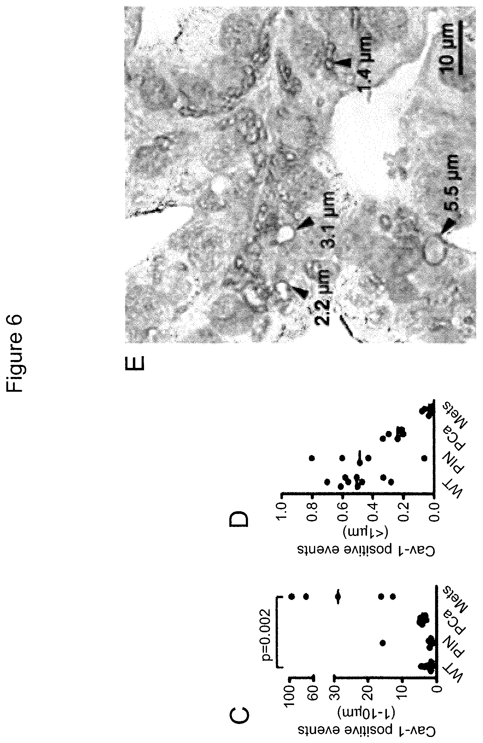Patent US12590965 Figure 12 – Palmitoyl protein biomarkers in purified extracellular vesicles for early identification of clinically significant prostate cancer