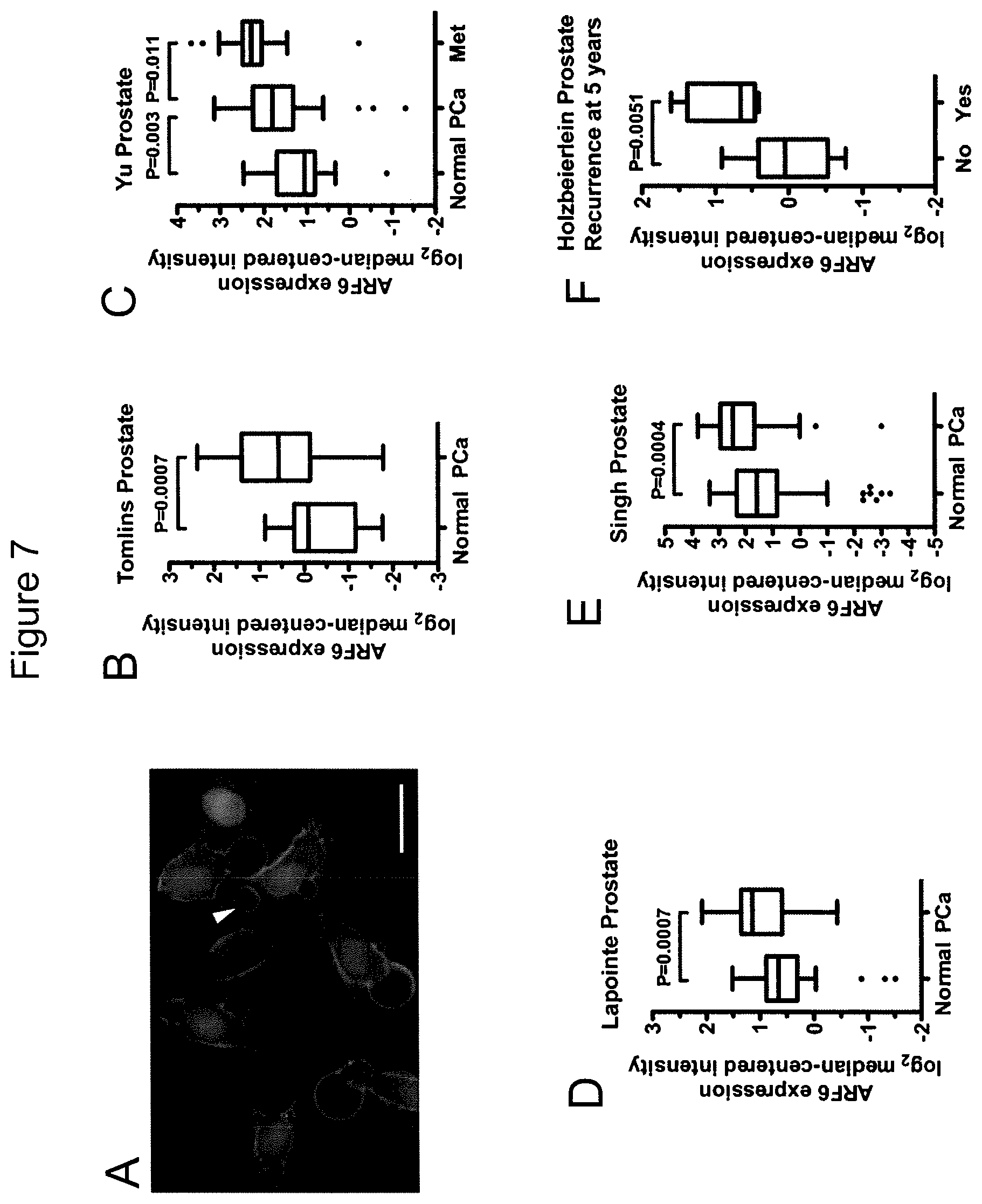 Patent US12590965 Figure 13 – Palmitoyl protein biomarkers in purified extracellular vesicles for early identification of clinically significant prostate cancer