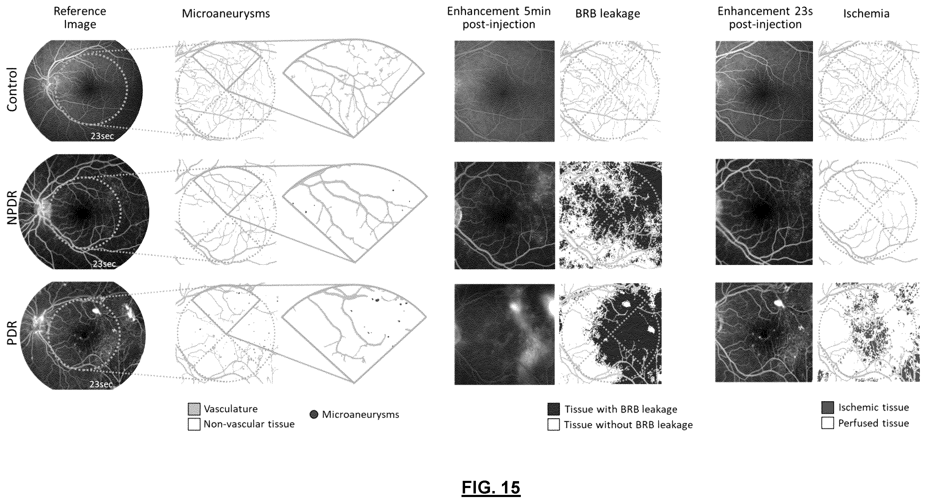 Patent US12592057 Figure 16 – System and method for detecting and classifying retinal microaneurysms