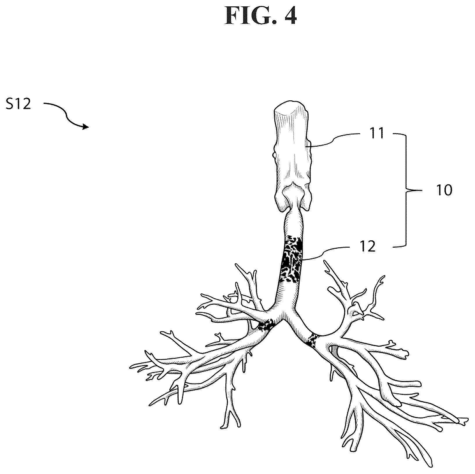 Patent US12592165 Figure 4 – Manufacturing method of bronchoscopy simulator