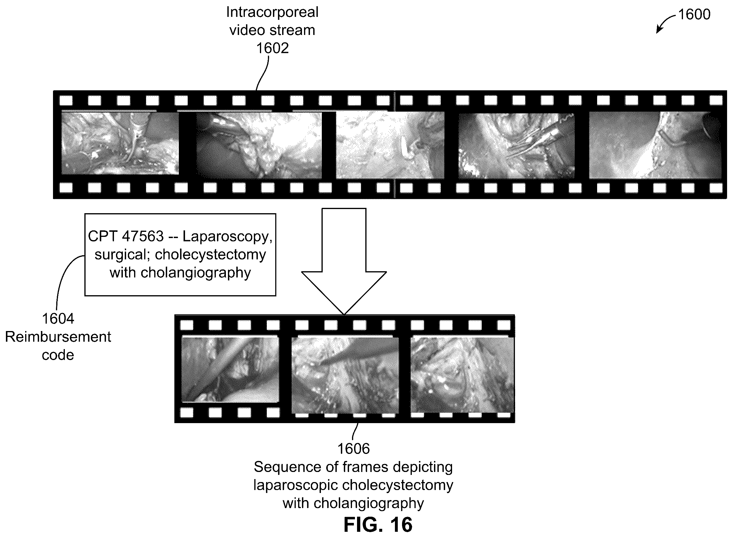 Patent US12592313 Figure 15 – Analyzing surgical videos to identify a billing coding mismatch