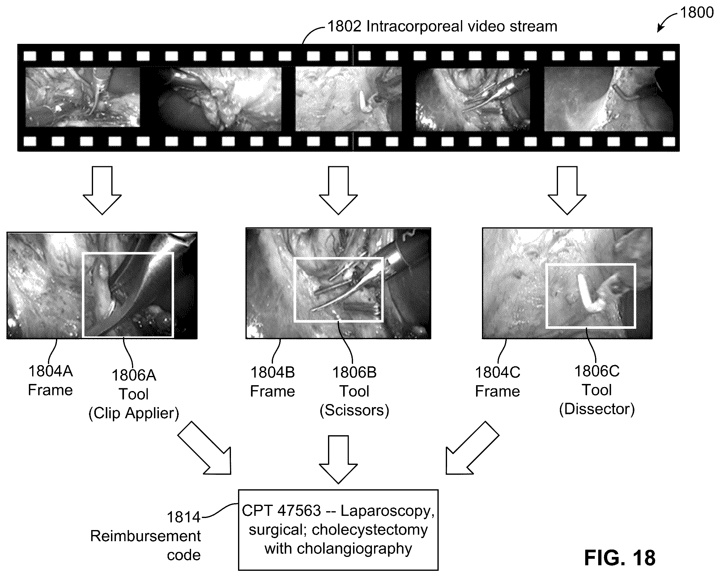 Patent US12592313 Figure 17 – Analyzing surgical videos to identify a billing coding mismatch