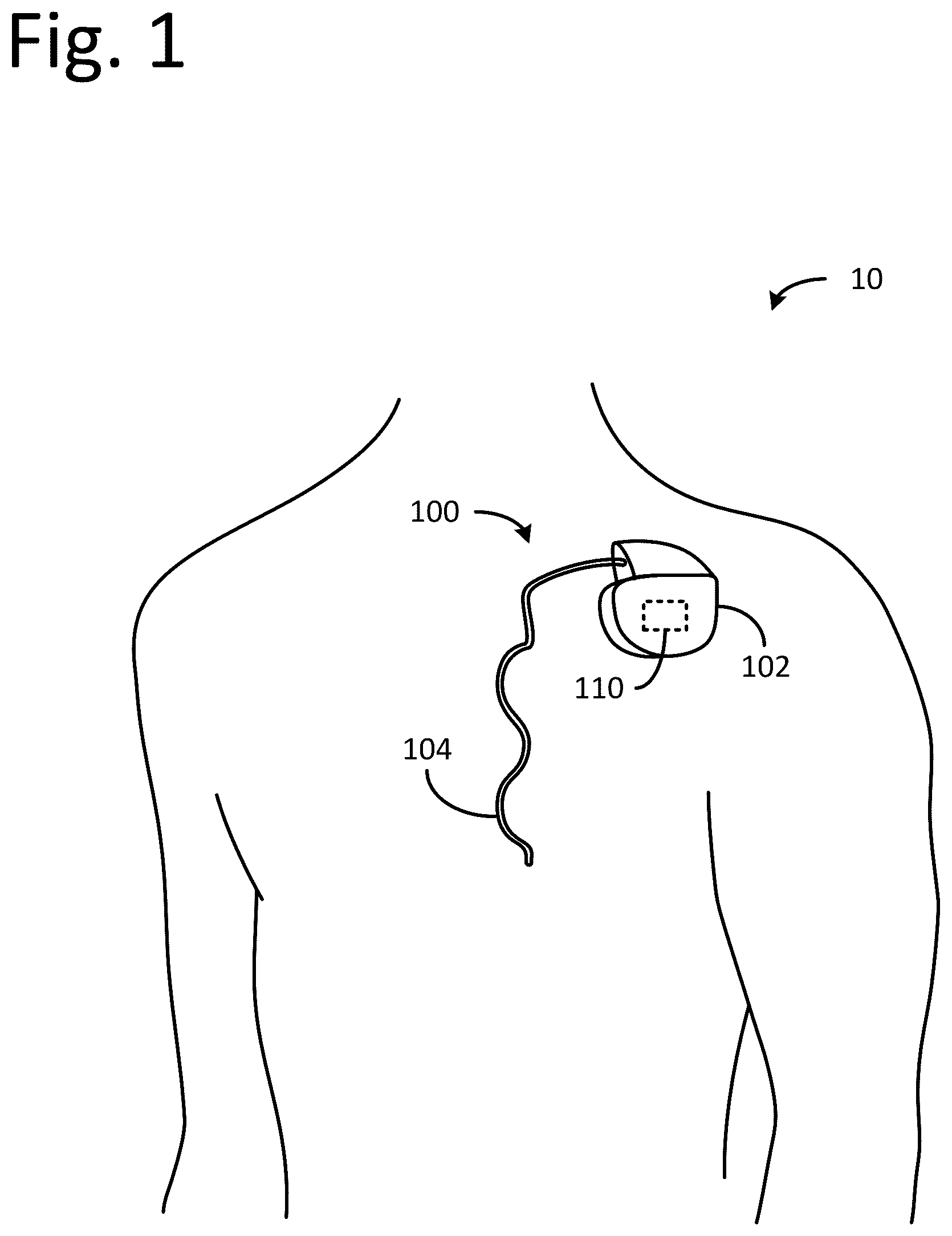 Patent US12592382 Figure 1 – Electrochemical cells with lithium alloy anodes