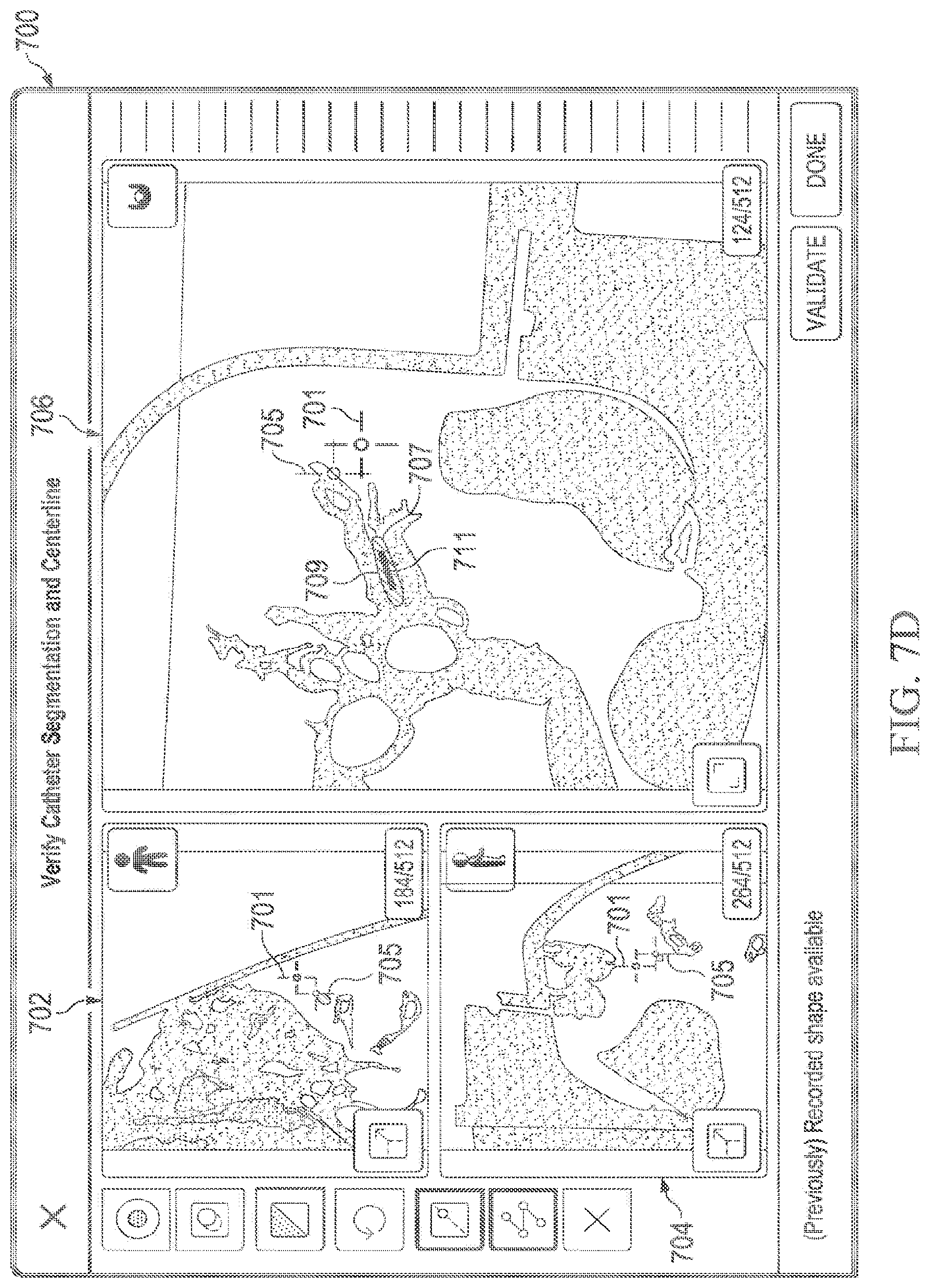 Patent US12597135 Figure 11 – Systems and methods for updating a graphical user interface based upon intraoperative imaging