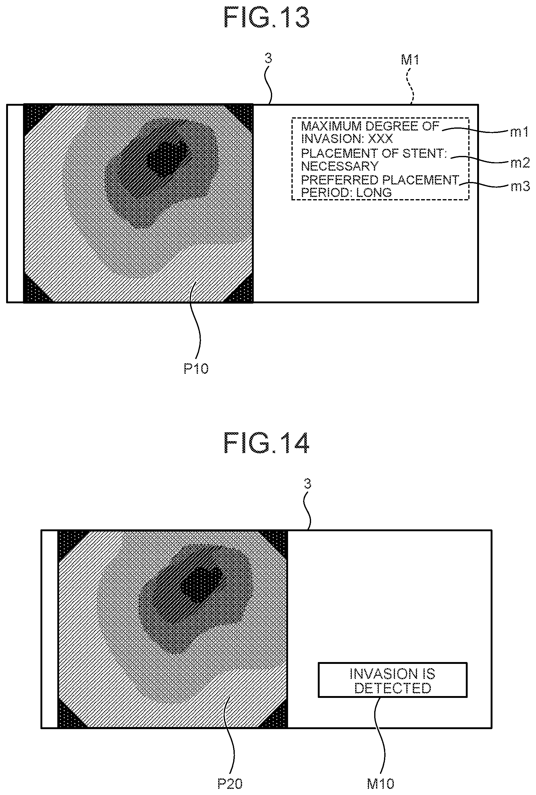 Patent US12599293 Figure 13 – Assist device, endoscope system, assist method and computer-readable recording medium