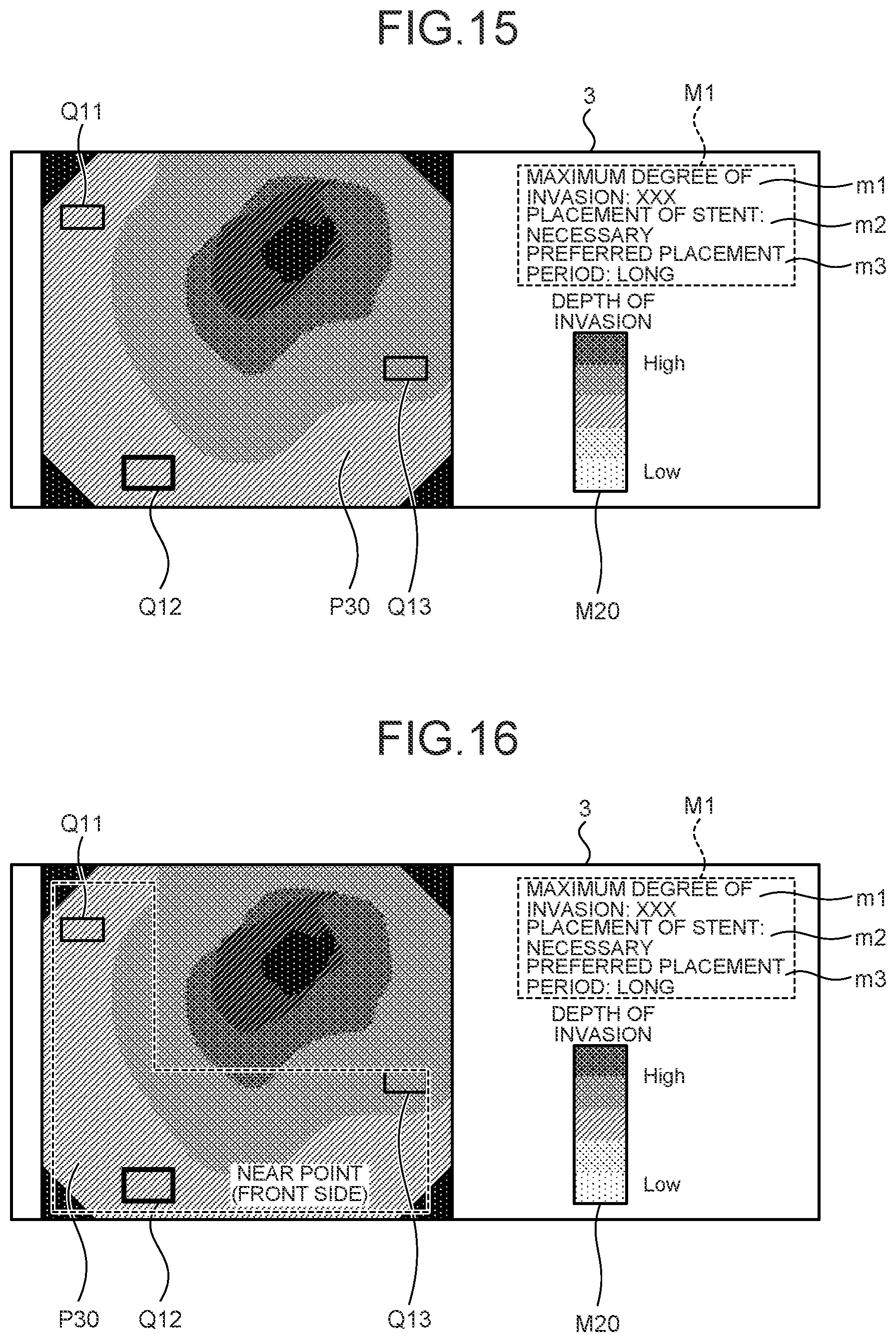 Patent US12599293 Figure 14 – Assist device, endoscope system, assist method and computer-readable recording medium