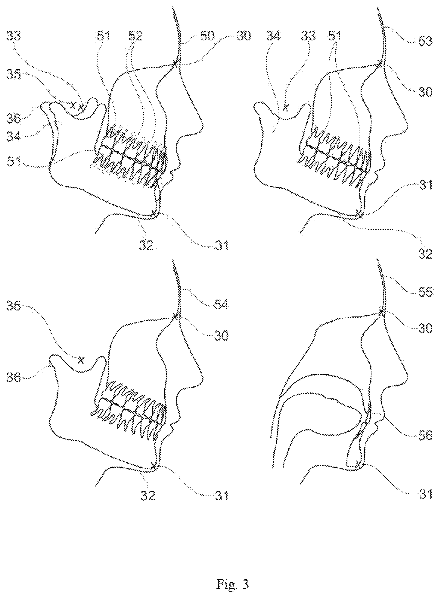 Patent US12599312 Figure 3 – Method for acquiring a dental object