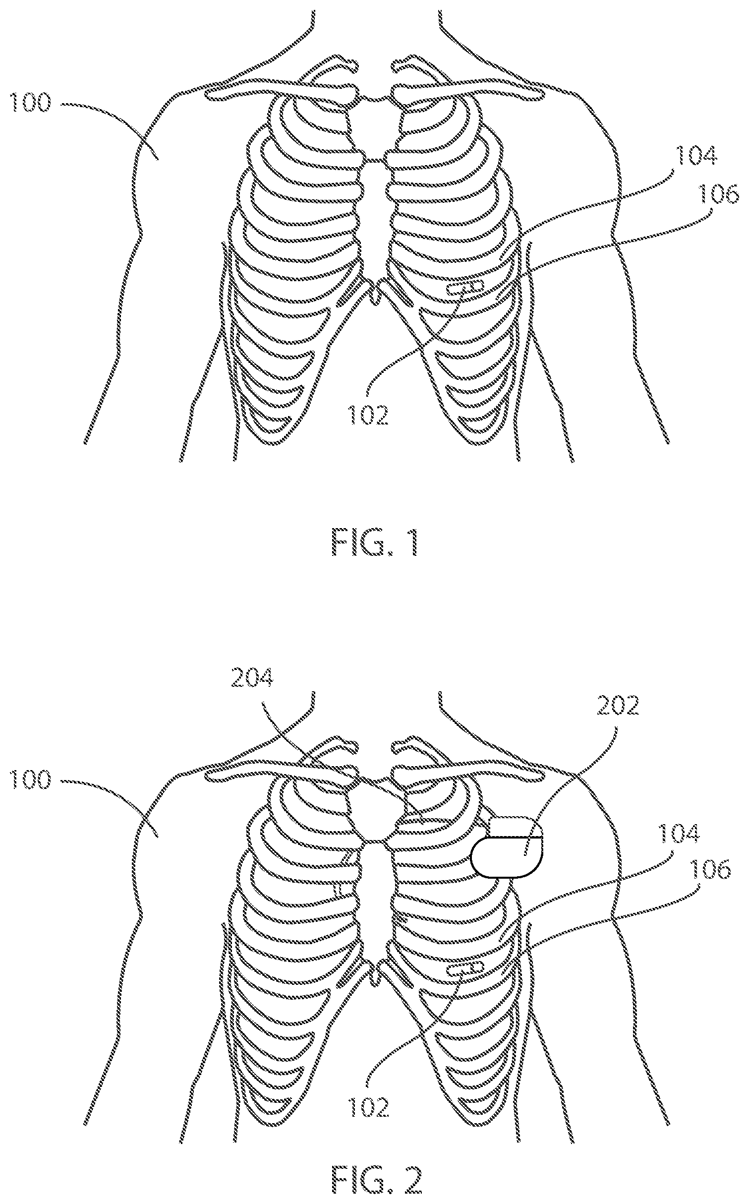 Patent US12599321 Figure 1 – Devices and methods for assessing pulmonary status using optical oxygenation sensing