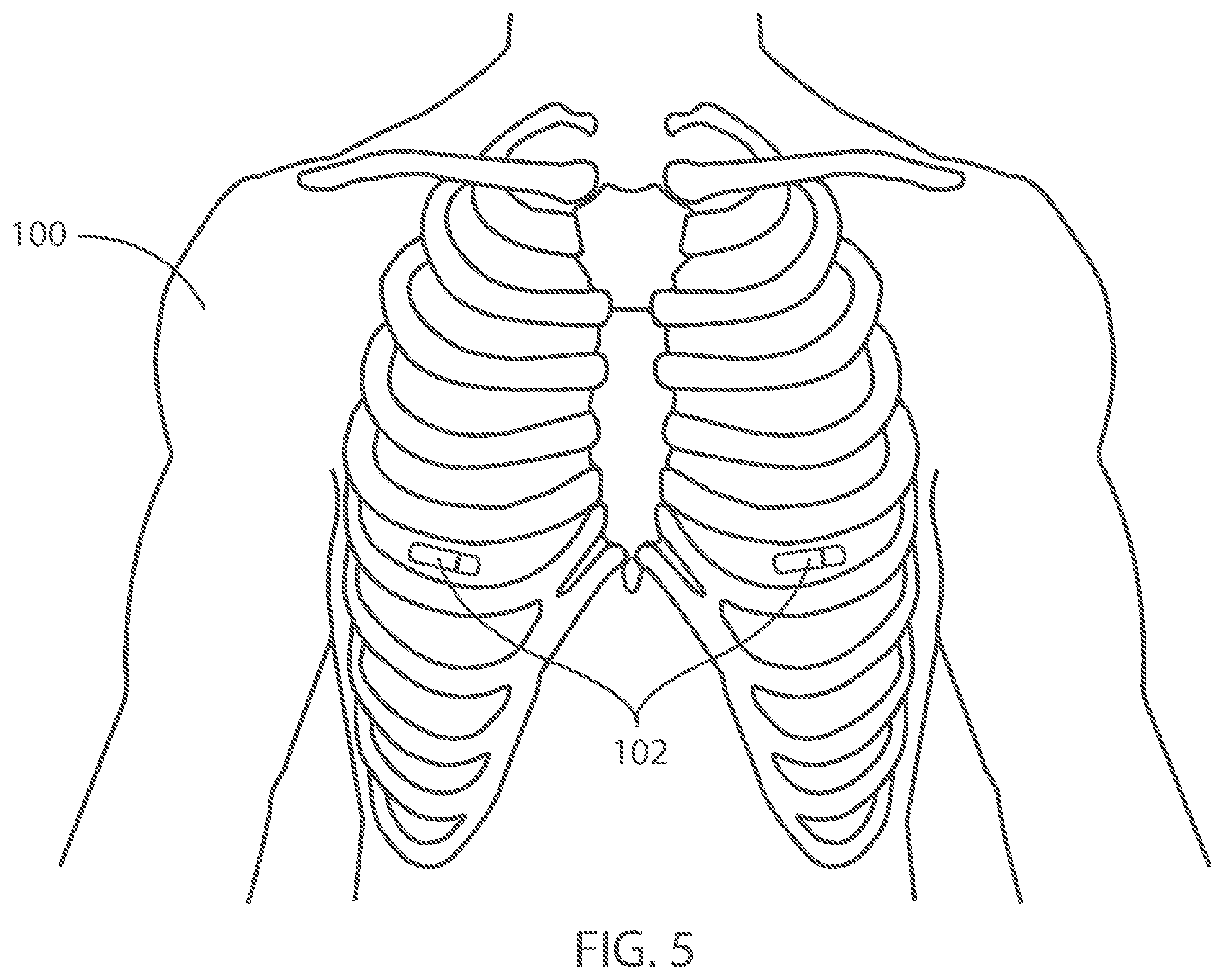 Patent US12599321 Figure 3 – Devices and methods for assessing pulmonary status using optical oxygenation sensing